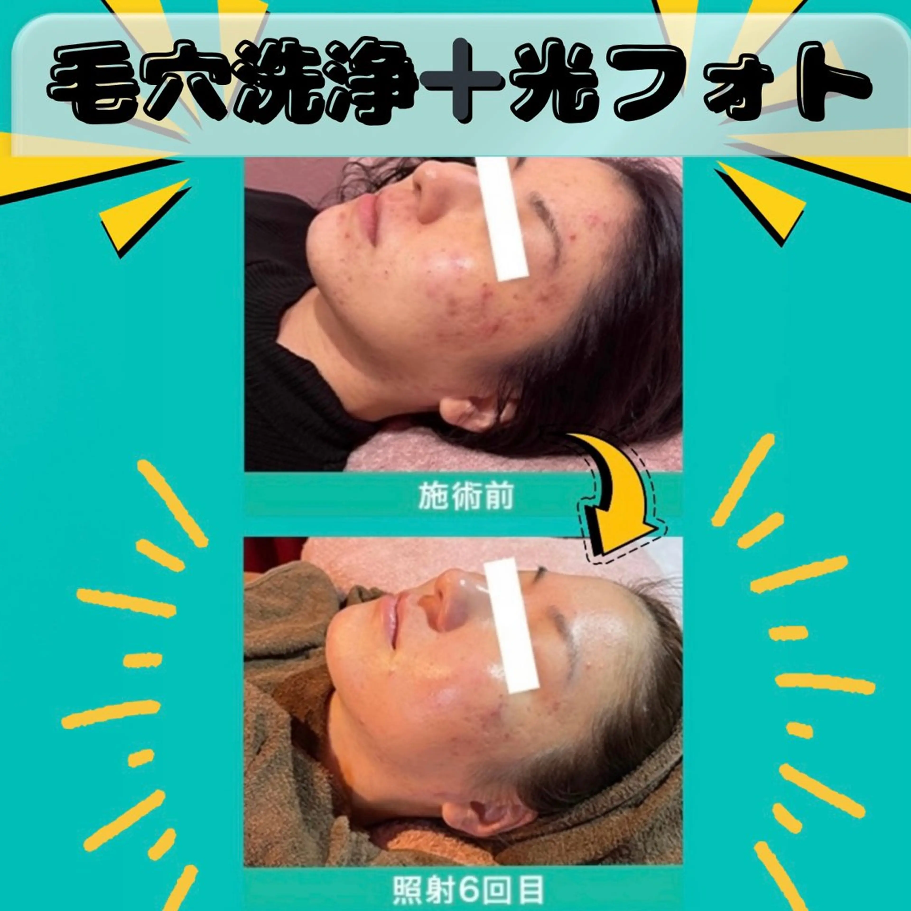 【ニキビ跡/シミ/赤み改善】光フォト✨️➕超音波毛穴洗浄🫧➕美白パック🌿の写真