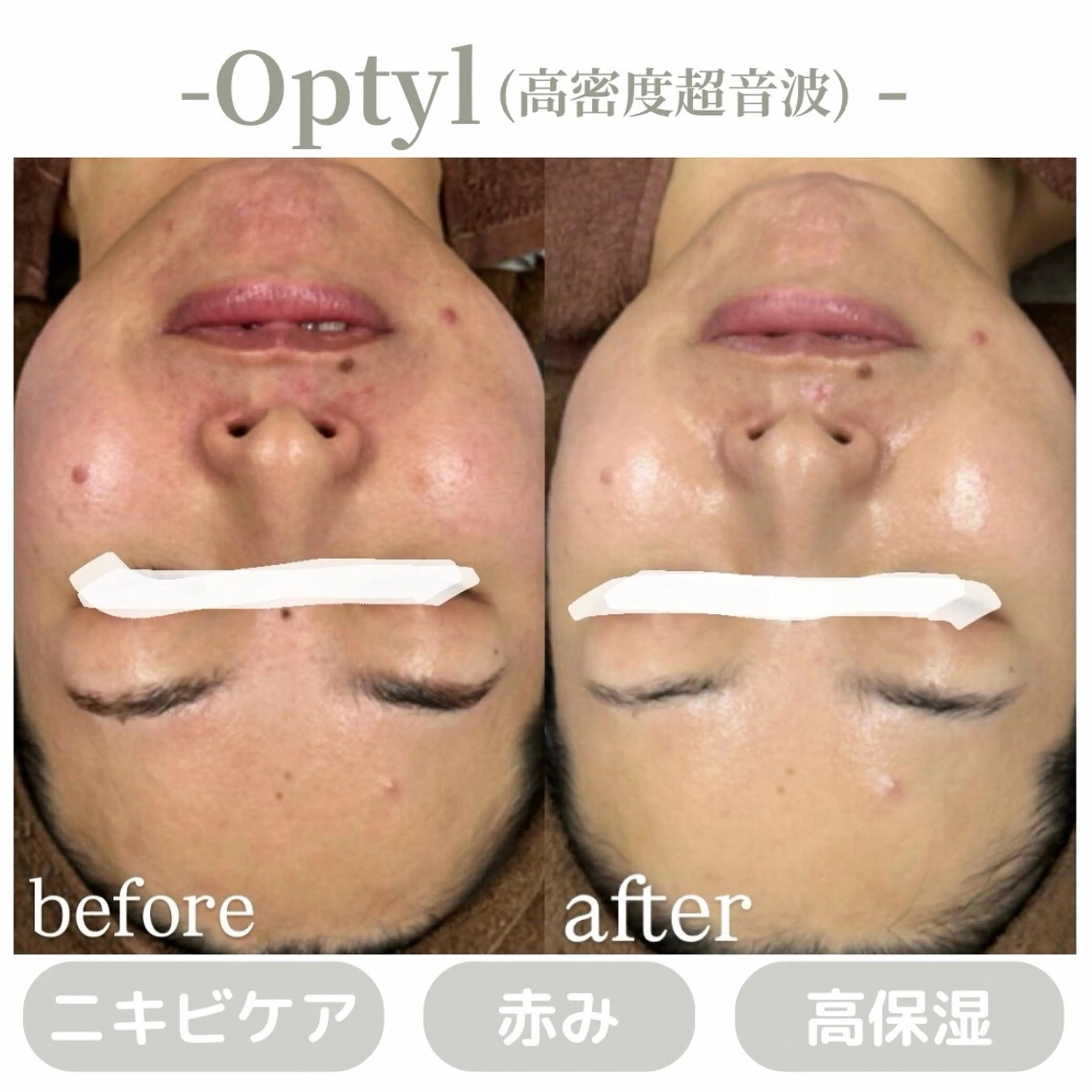 エステ 肌質改善|天王寺 For...はるかのエステ・リラクイメージ