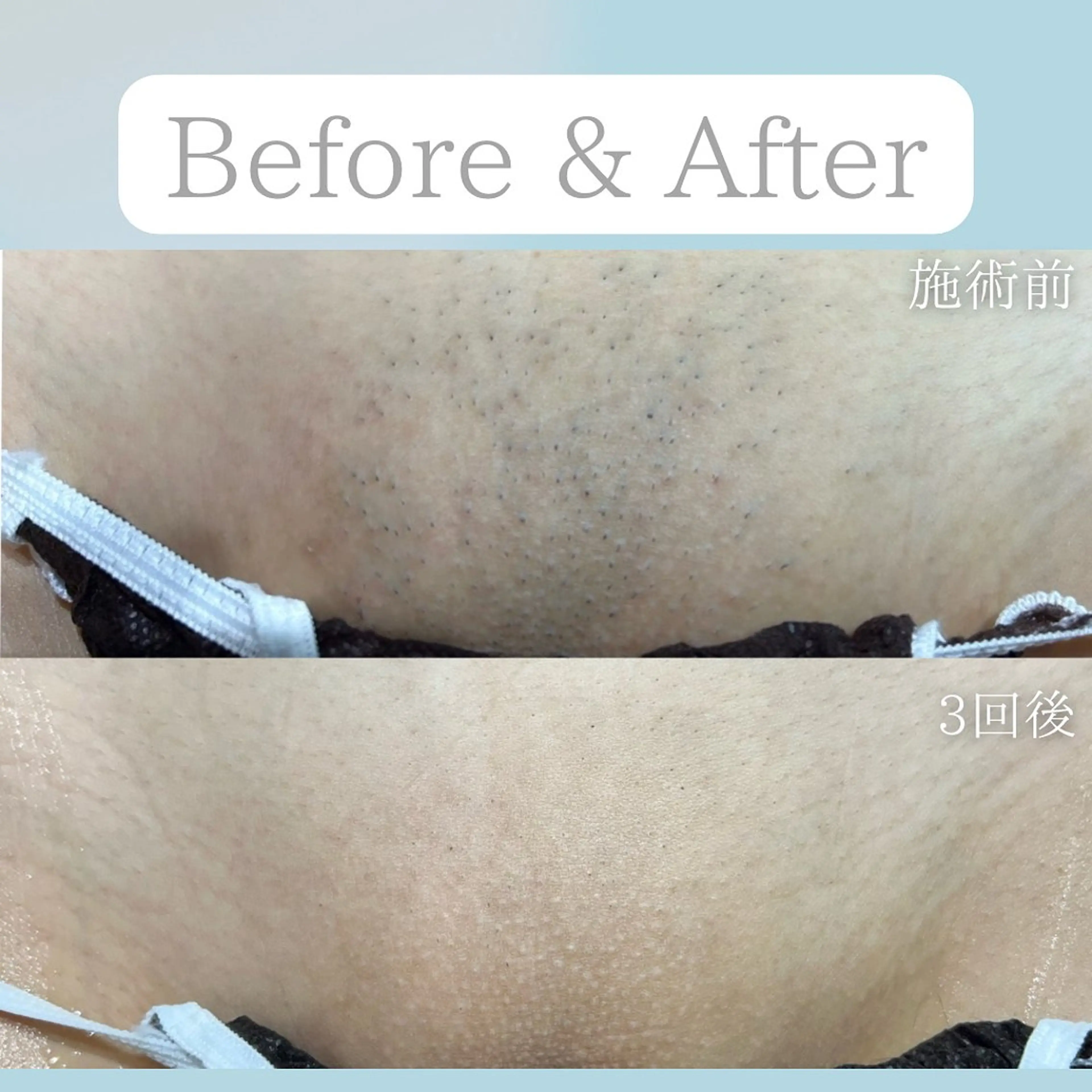 美肌脱毛&毛穴専門 Nico🐰ྀི♡のエステ・リラクイメージ