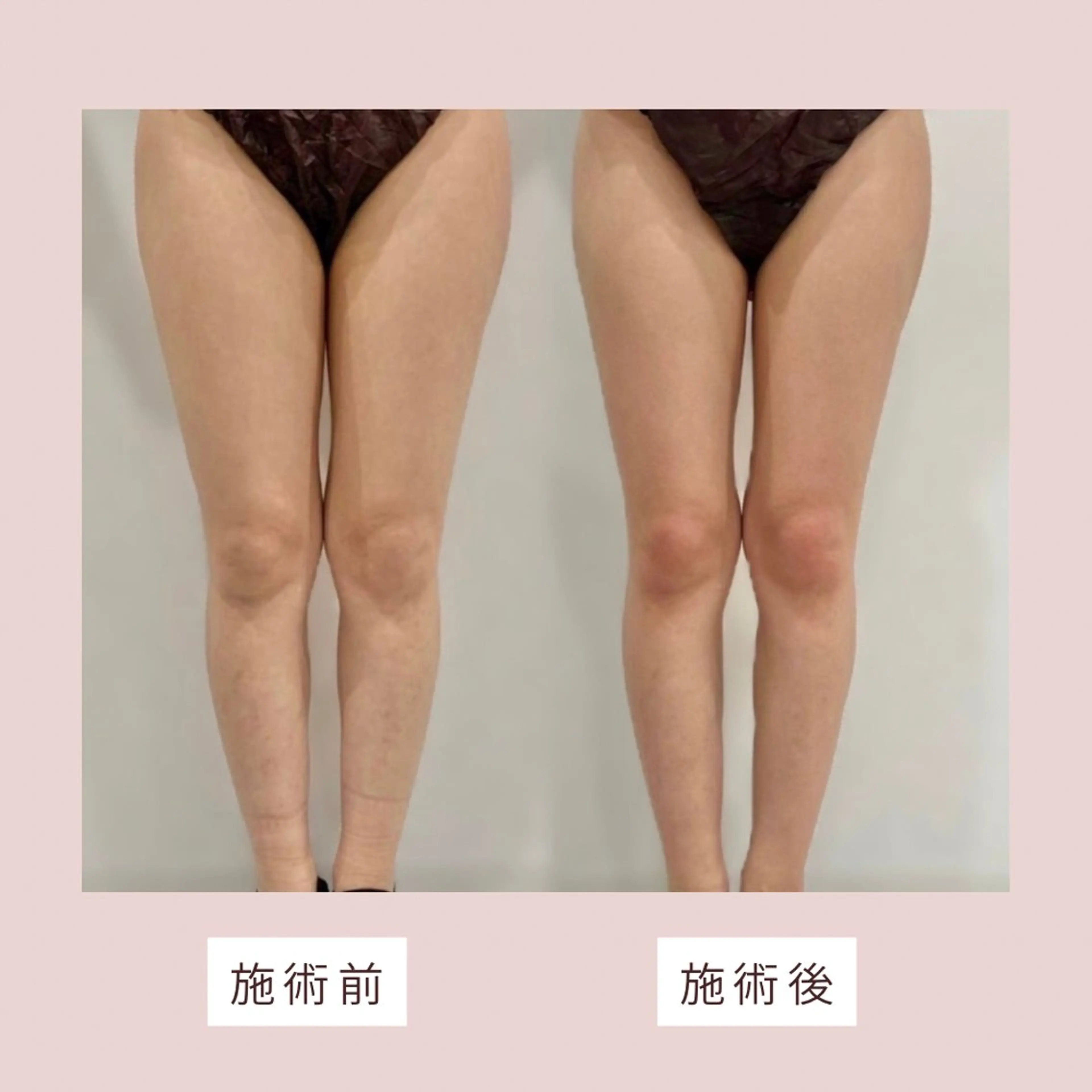 モニター価格🌸肩こりやむくみにお悩みの方へ✨インディバボディ90分✨️の写真