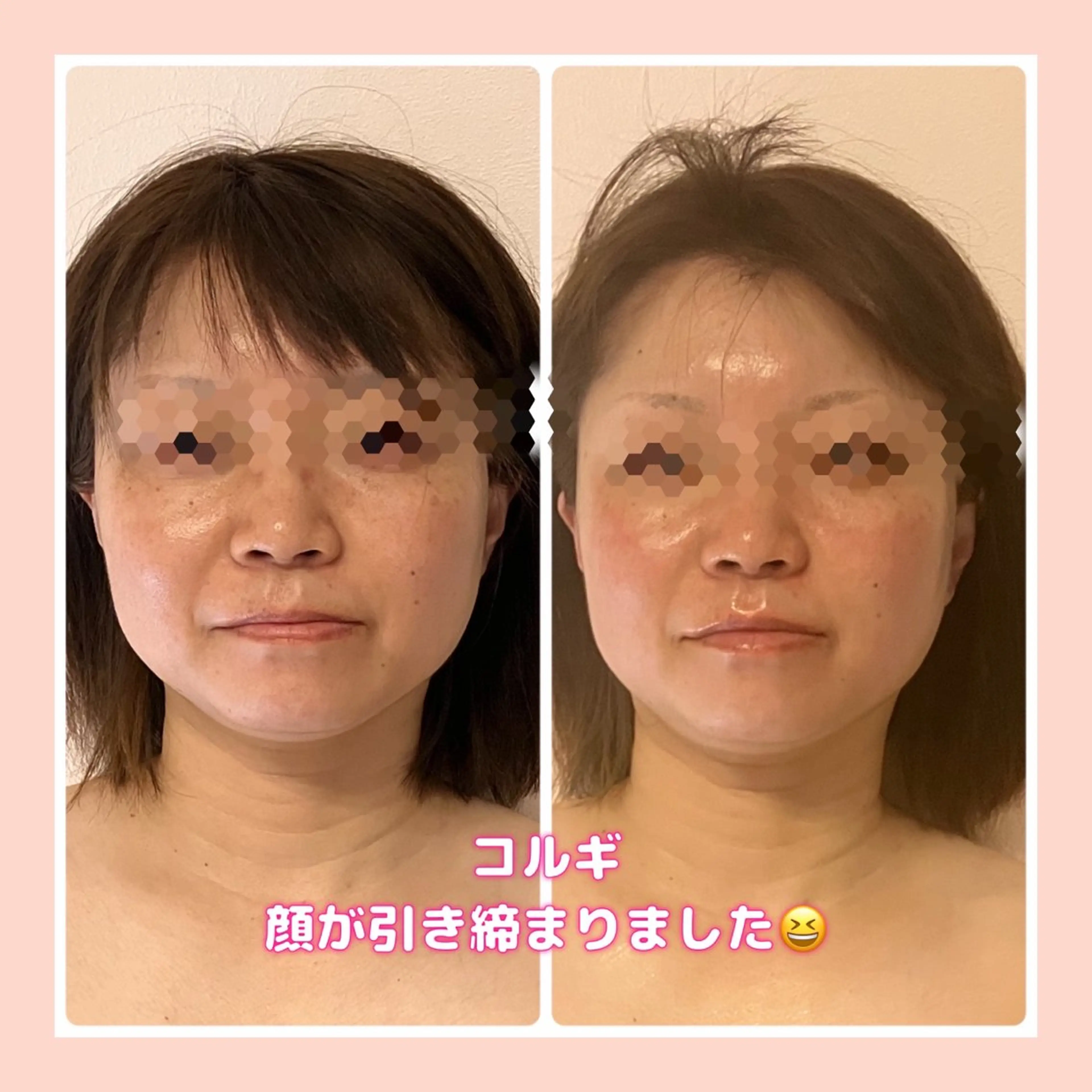 最強美肌ケア！毛穴黒ずみ、ハイドラ毛穴洗浄x小顔コルギ　徹底的に美肌を目指したい！そんな方に◎の写真