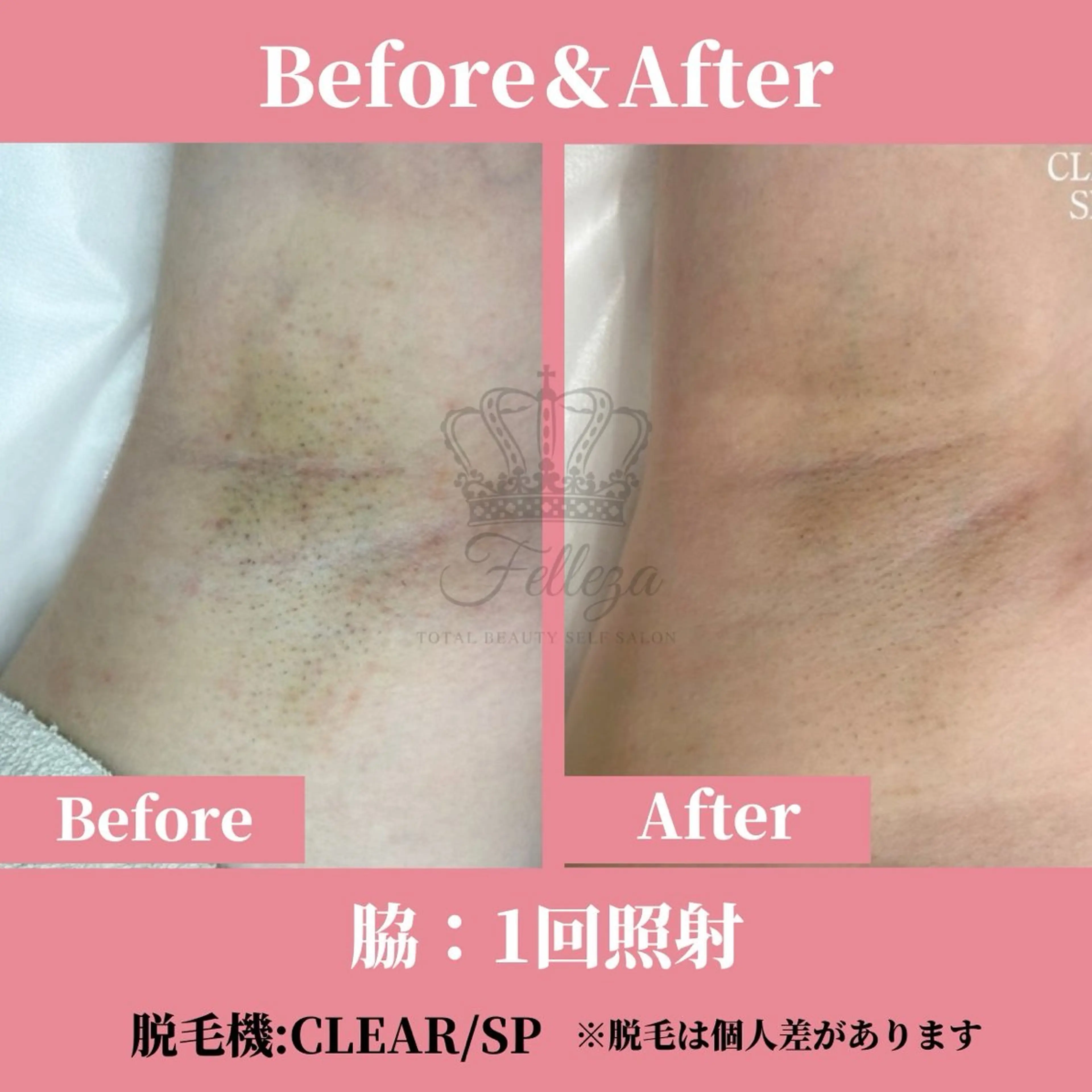 メンズ キッズ 有人型セルフサロン 脱毛/痩身/美顔のその他イメージ