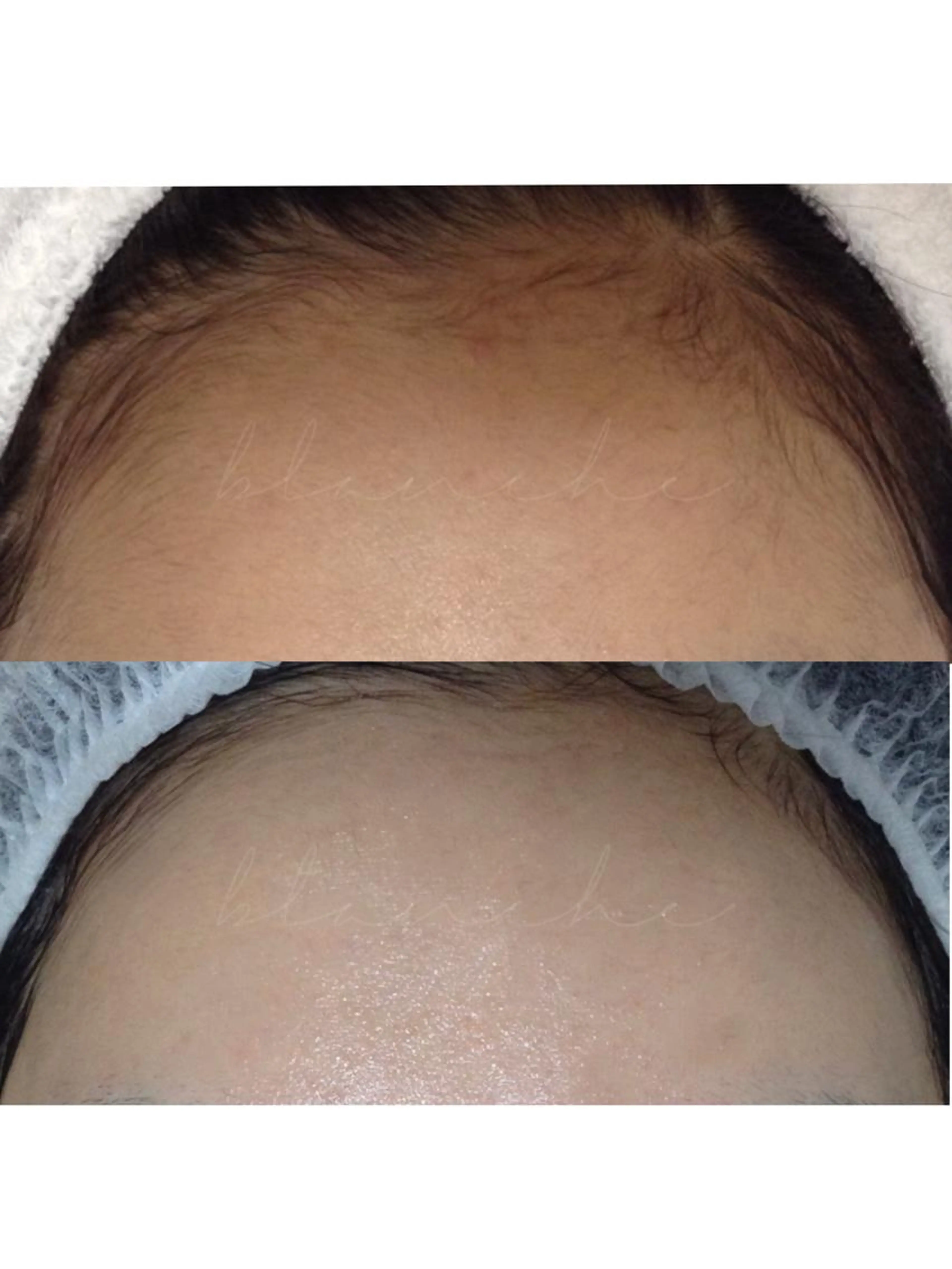 お顔つるんつるんっ💎✨お顔脱毛体験コース♥️美容液を約30​〜​100倍浸透させながら完全無痛で脱毛出来ちゃいます❣️の写真