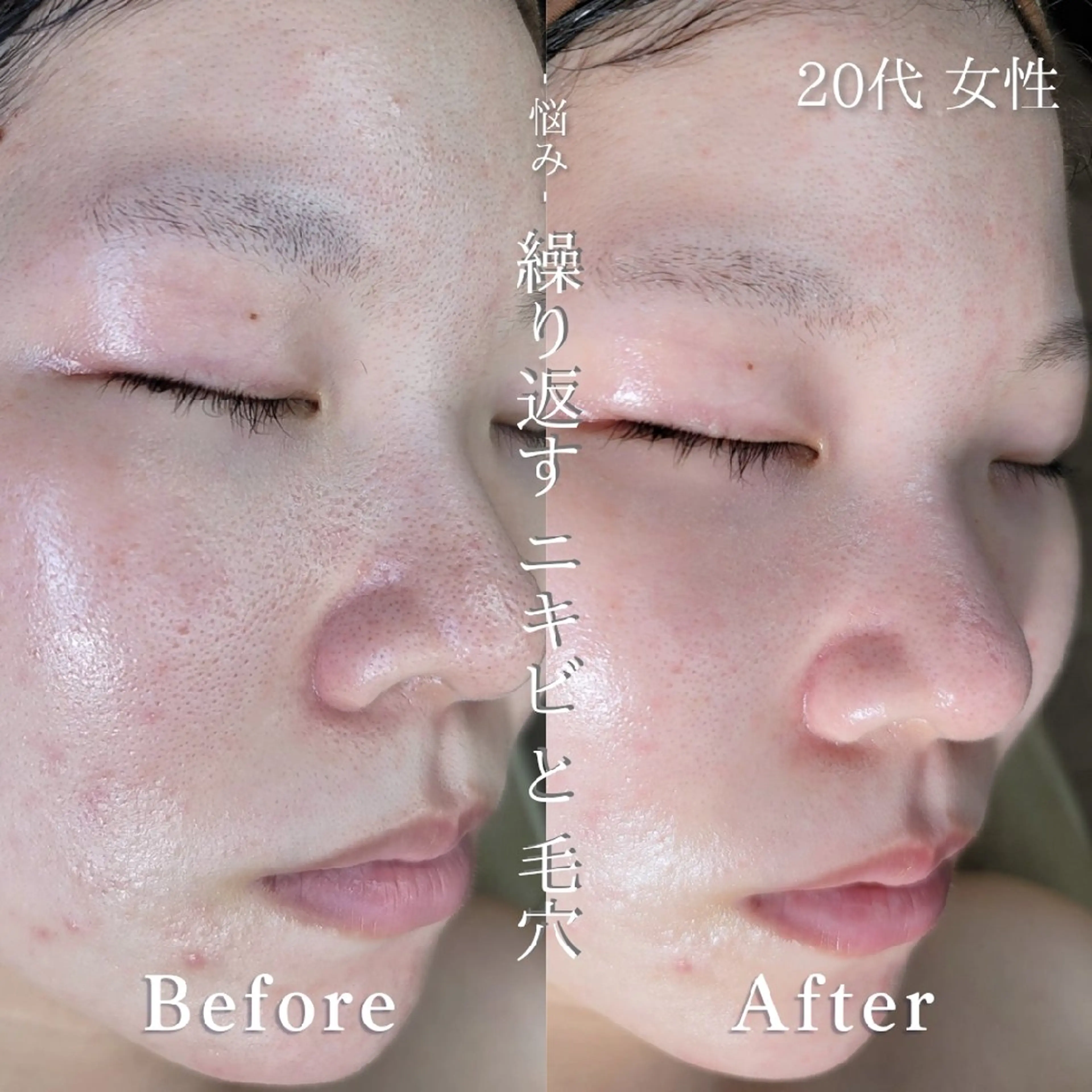 era: kayla 毛穴・ニキビ改善のエステ・リラクイメージ