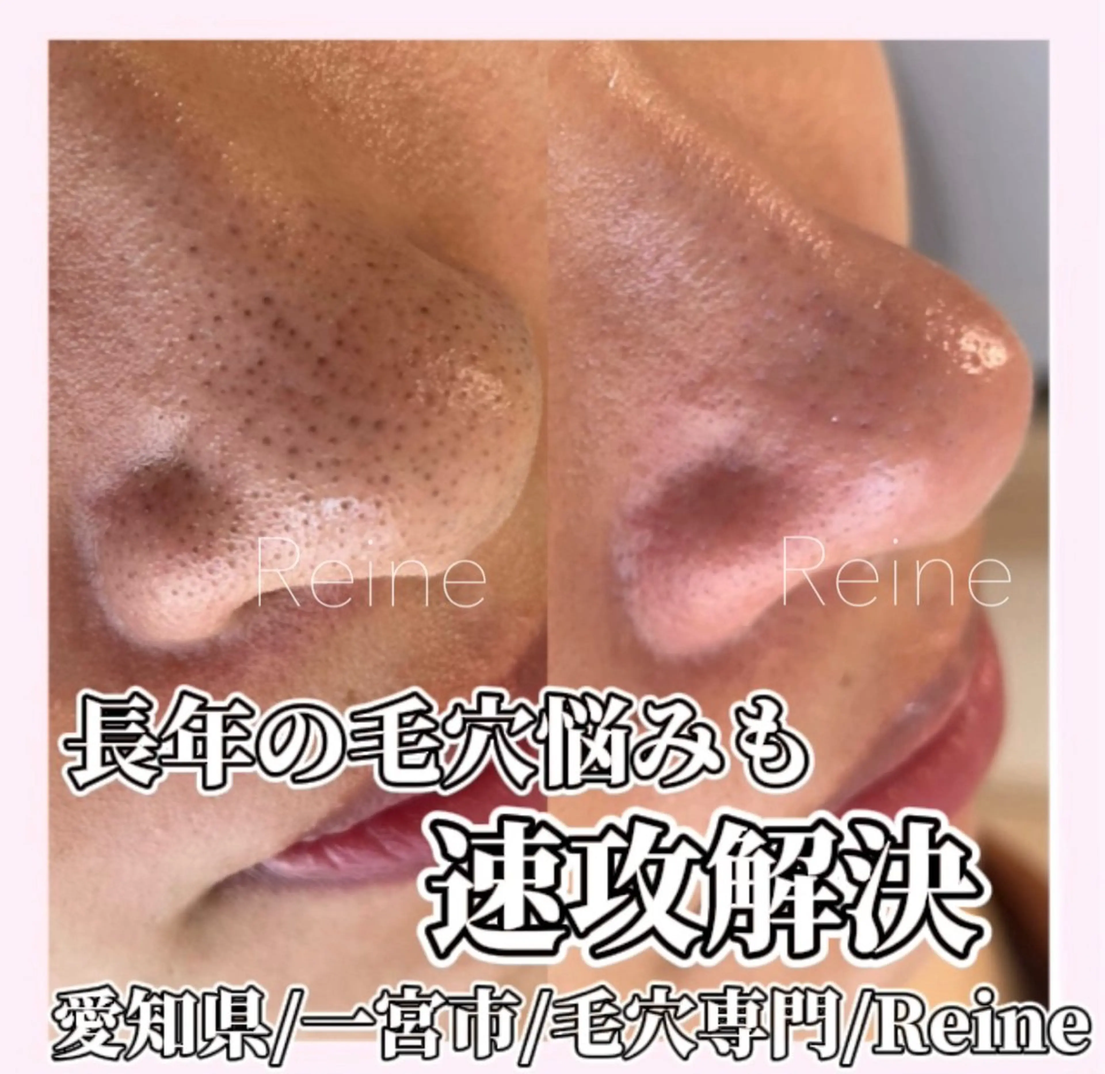 エステ Reine BeautySalon所属・毛穴/シミ肝斑/脱毛 横山梨里のエステ・リラクイメージ