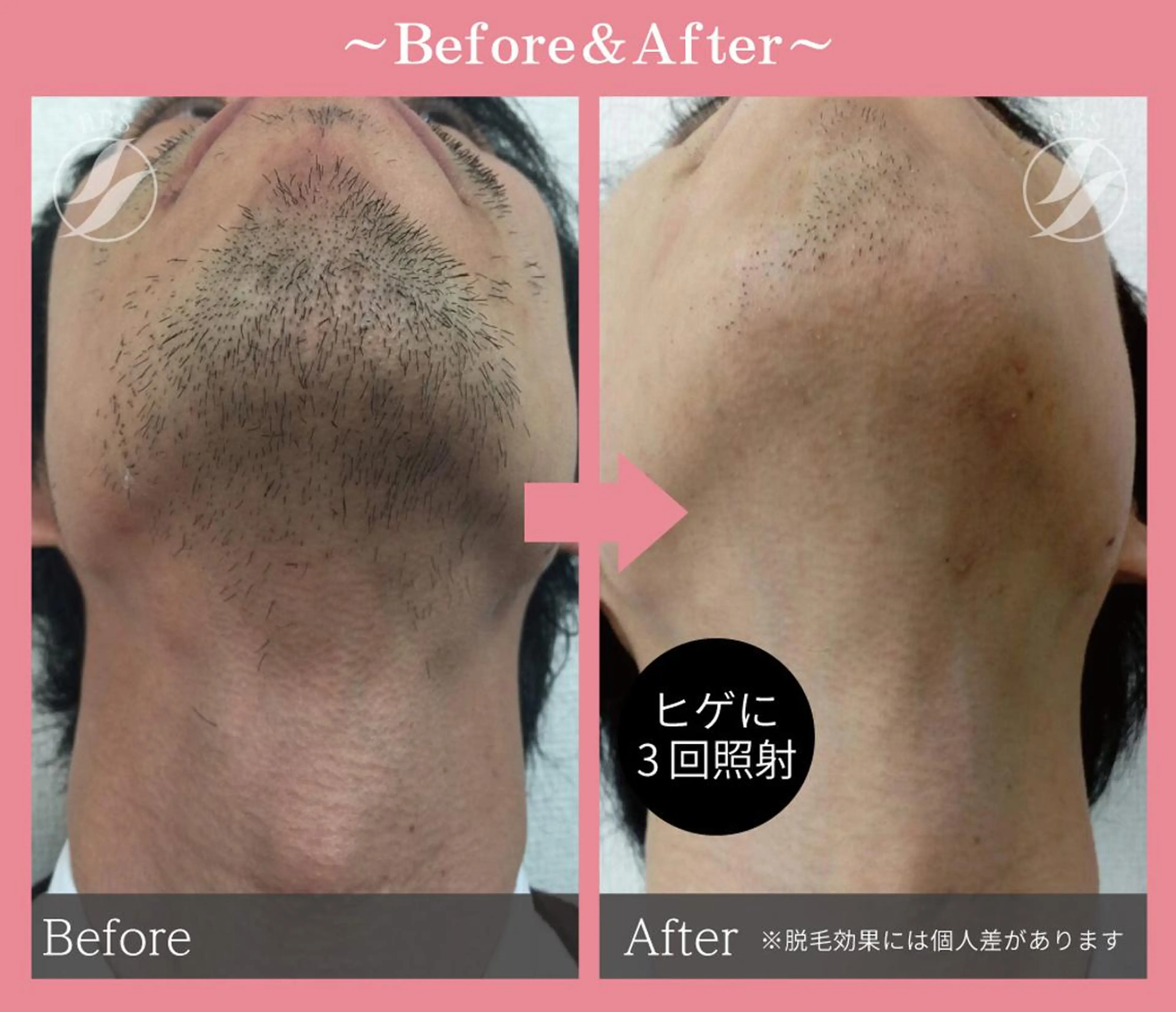 ⭐️人気No. 1⭐️最新機器で、すっきり爽やか髭脱毛(おでこ、両頬、鼻下、フェイスライン、顎、顎下)美肌鎮静パック付きの写真