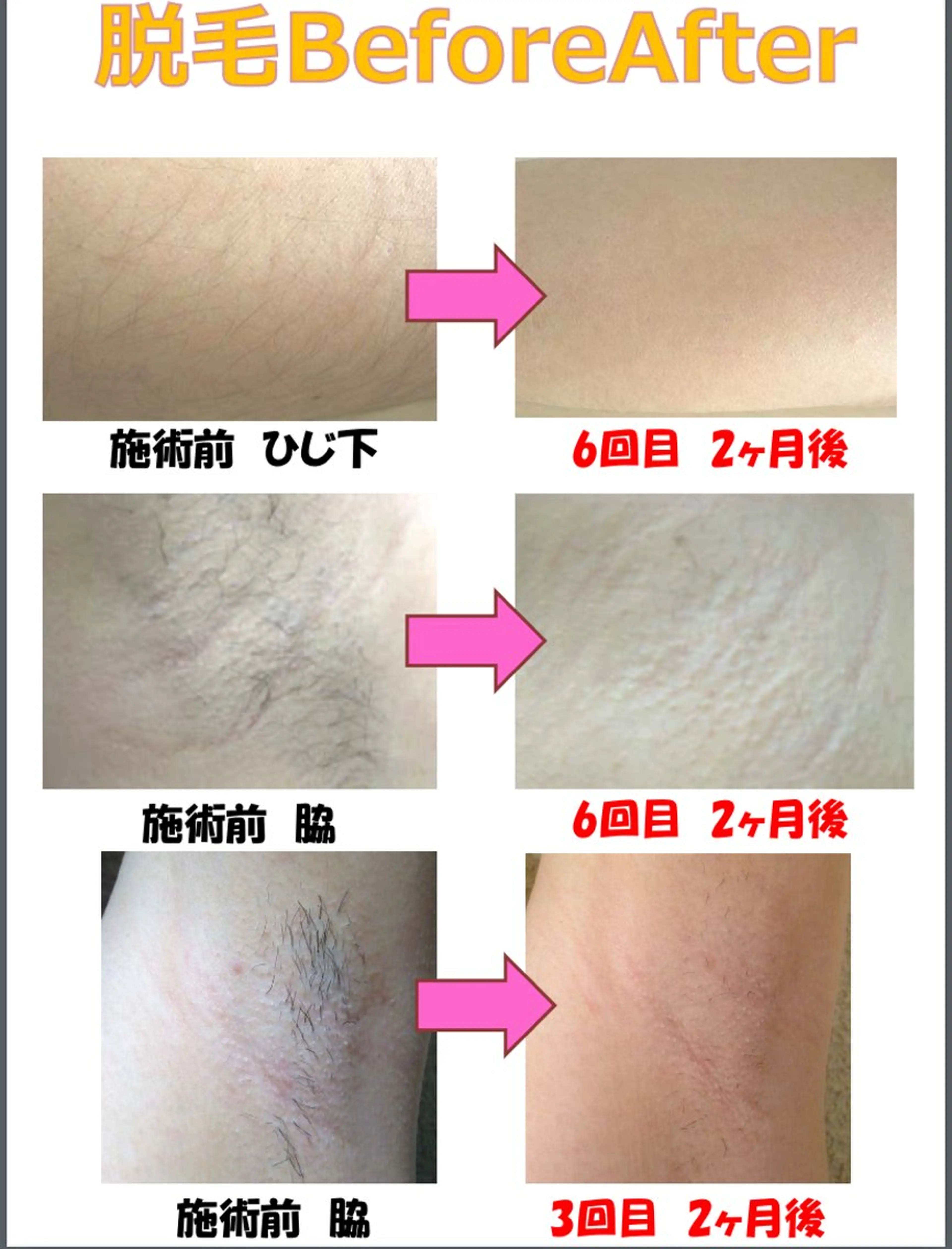 脱毛無料カウンセリングの写真
