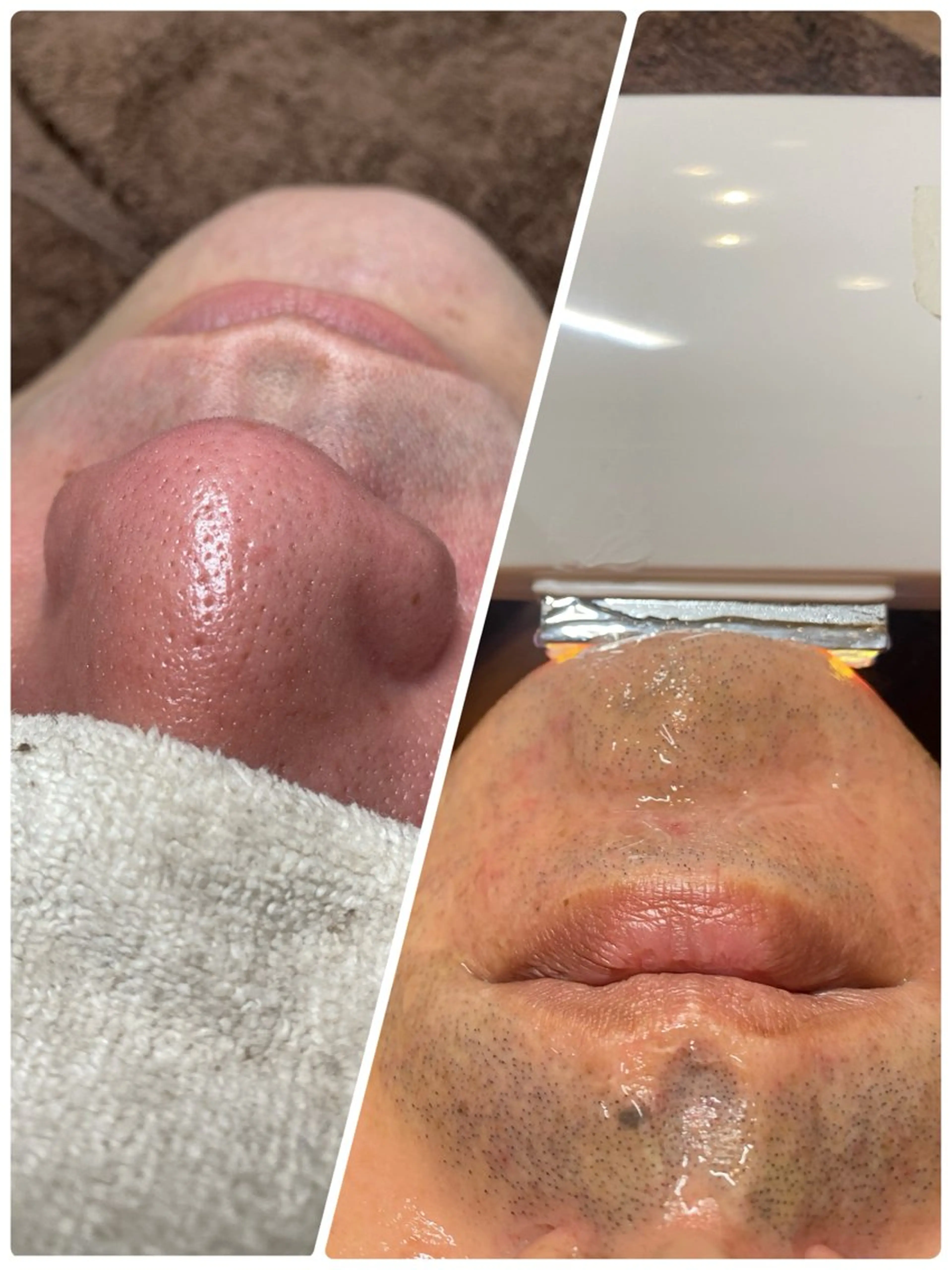 【メンズ脱毛】ヒゲ脱毛+顔全体毛穴洗浄ハイドラ  顔マッサージ付き 15,000円→8,800円の写真