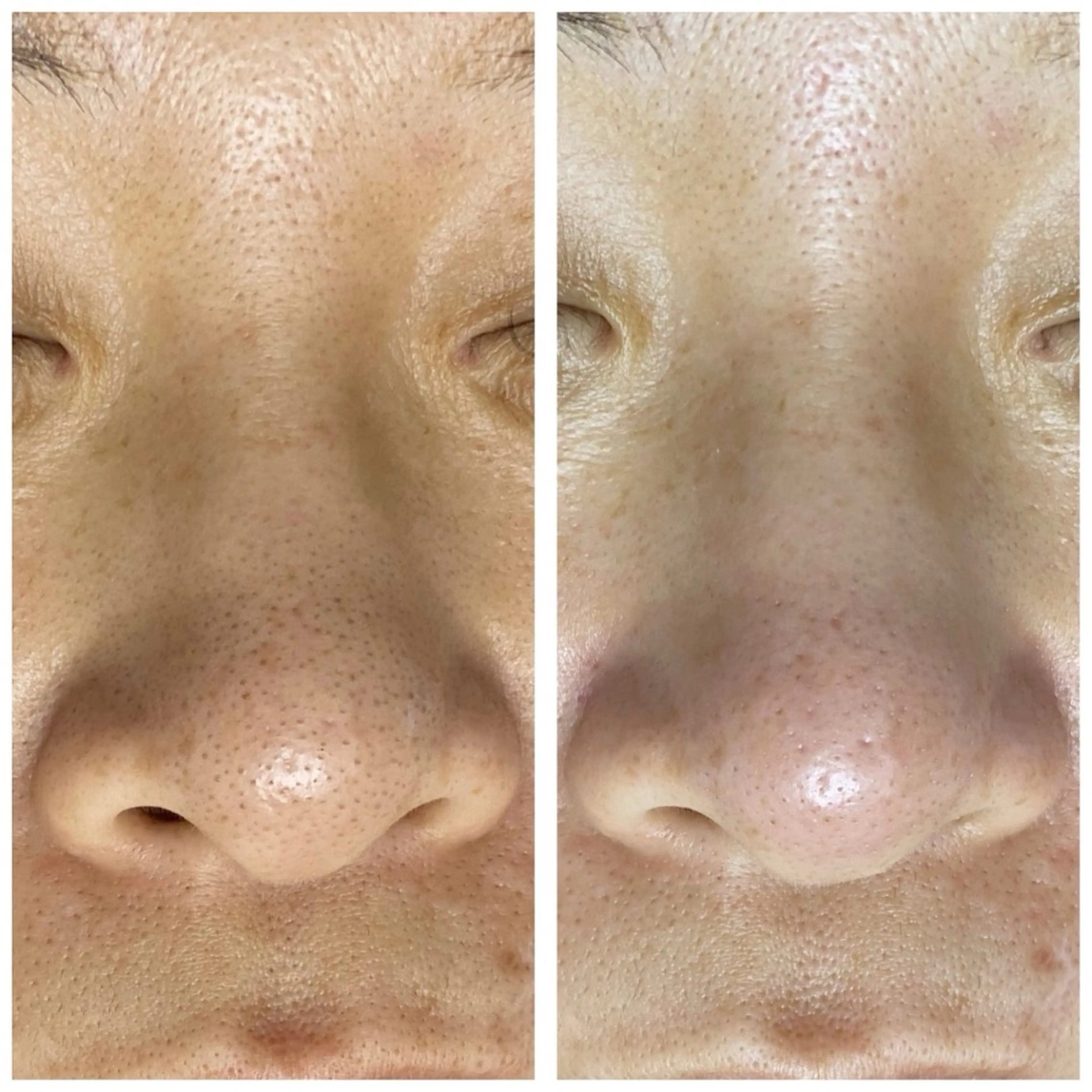 『ザラザラ肌とはお別れ!』ハイドラフェイシャルから毛穴引き締めまでのセット◎の写真