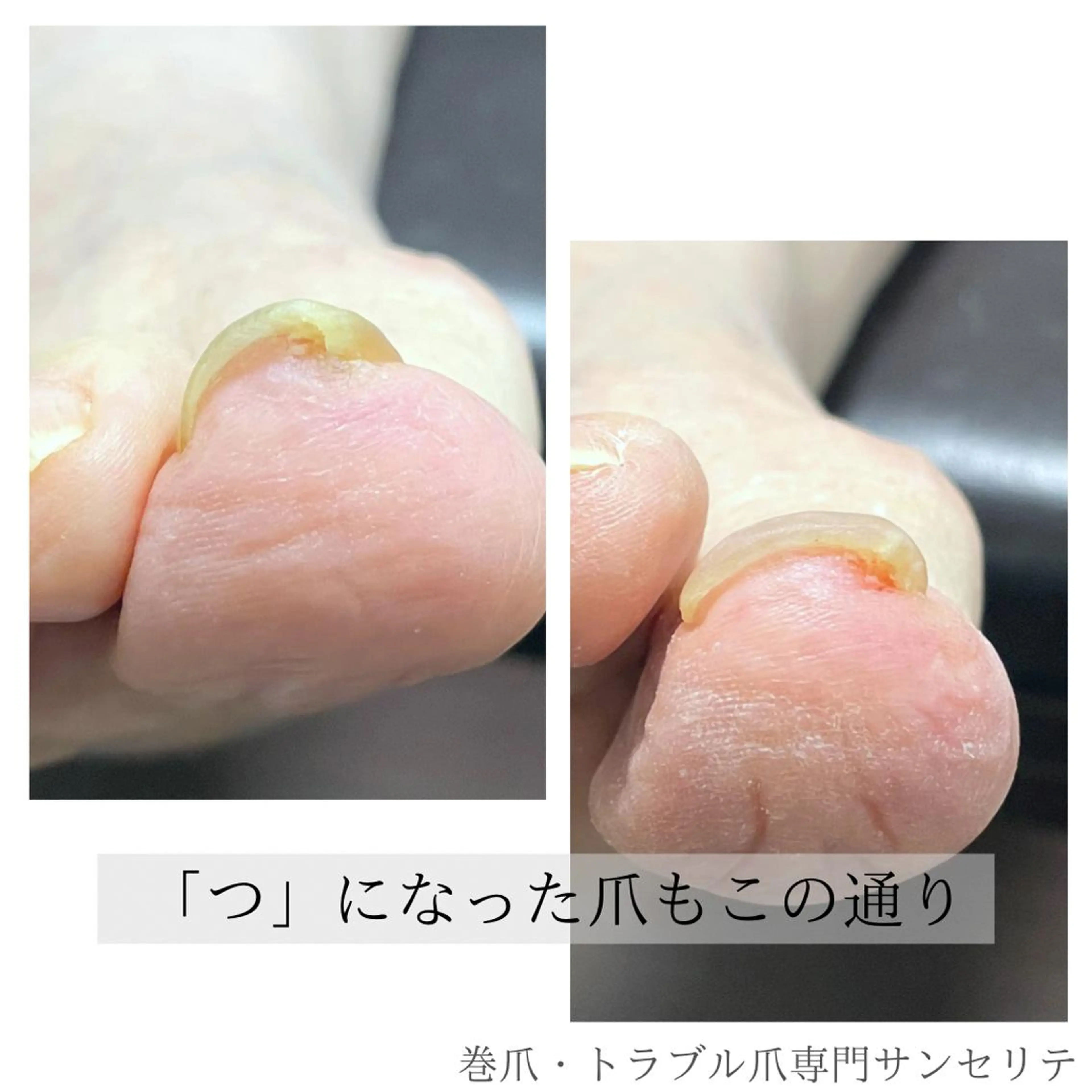 ネイル フットネイル 深爪・巻き爪 専門サンセリテのネイルデザイン