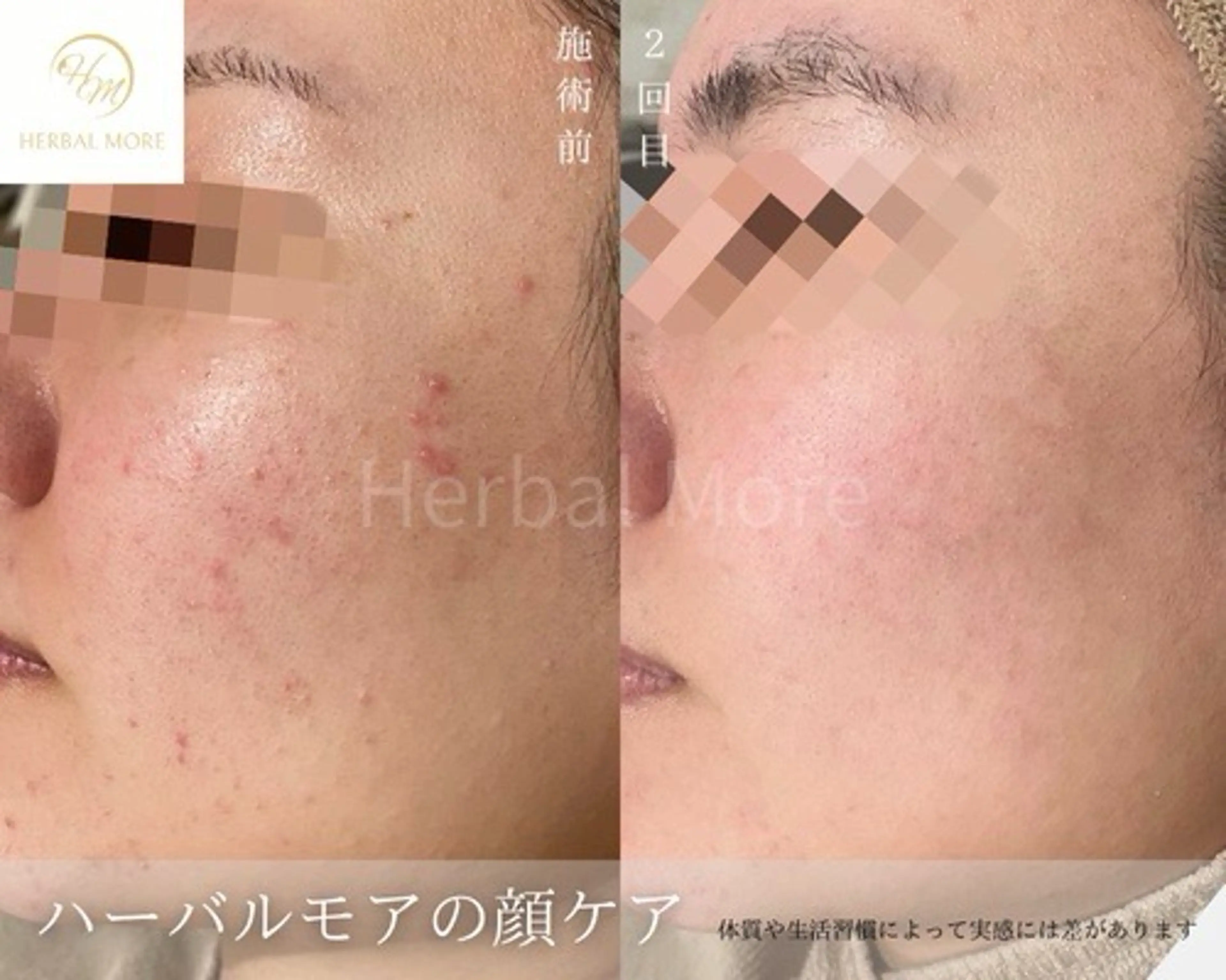 ハーブピーリング【背中】撮影モデル📷1​〜​8段階選べる施術💆‍♀️ホームケアローション60ml付き🧴🌿の写真