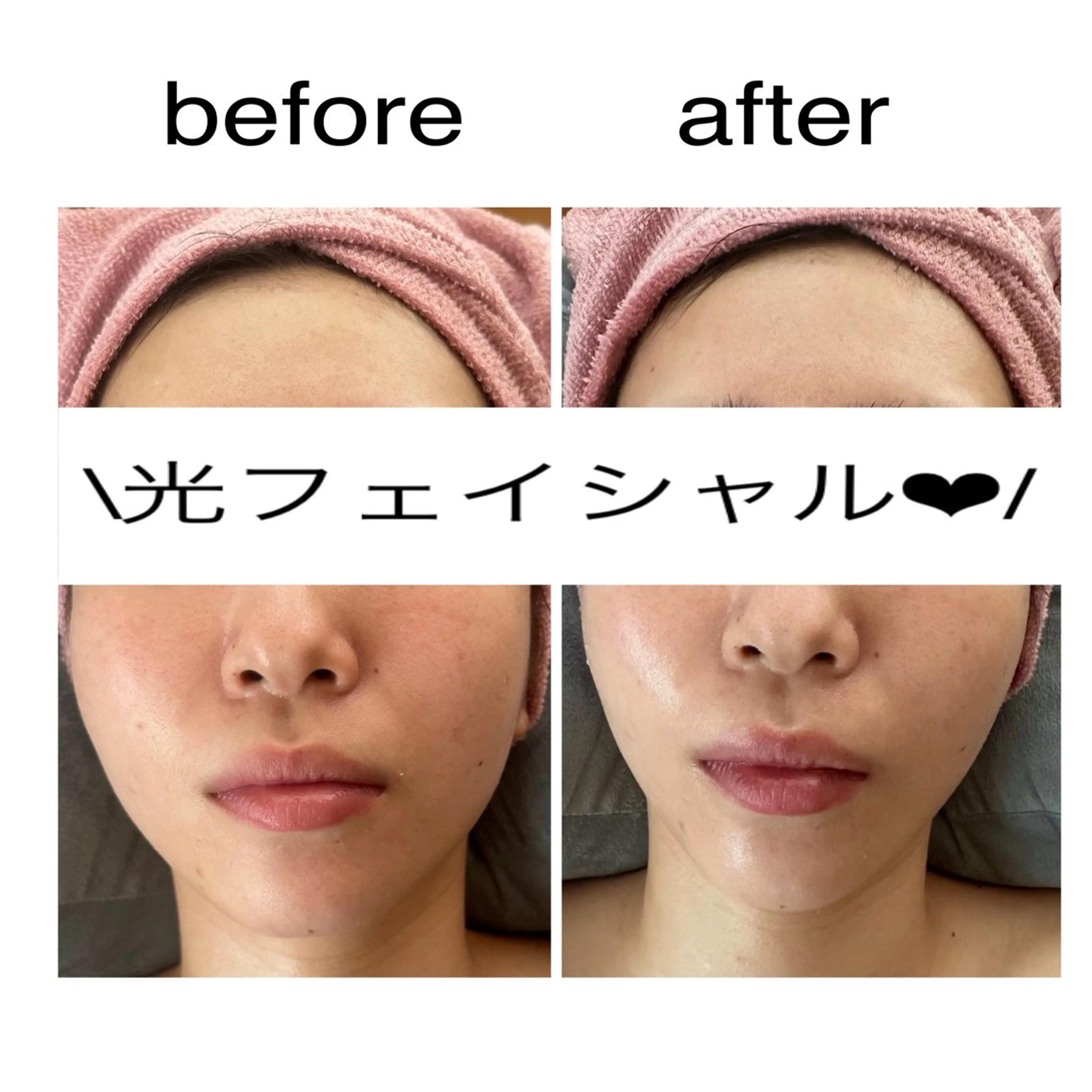 【ハリツヤUP小顔に💛】光フェイシャル(お顔、デコルテ)＋保湿パックの写真