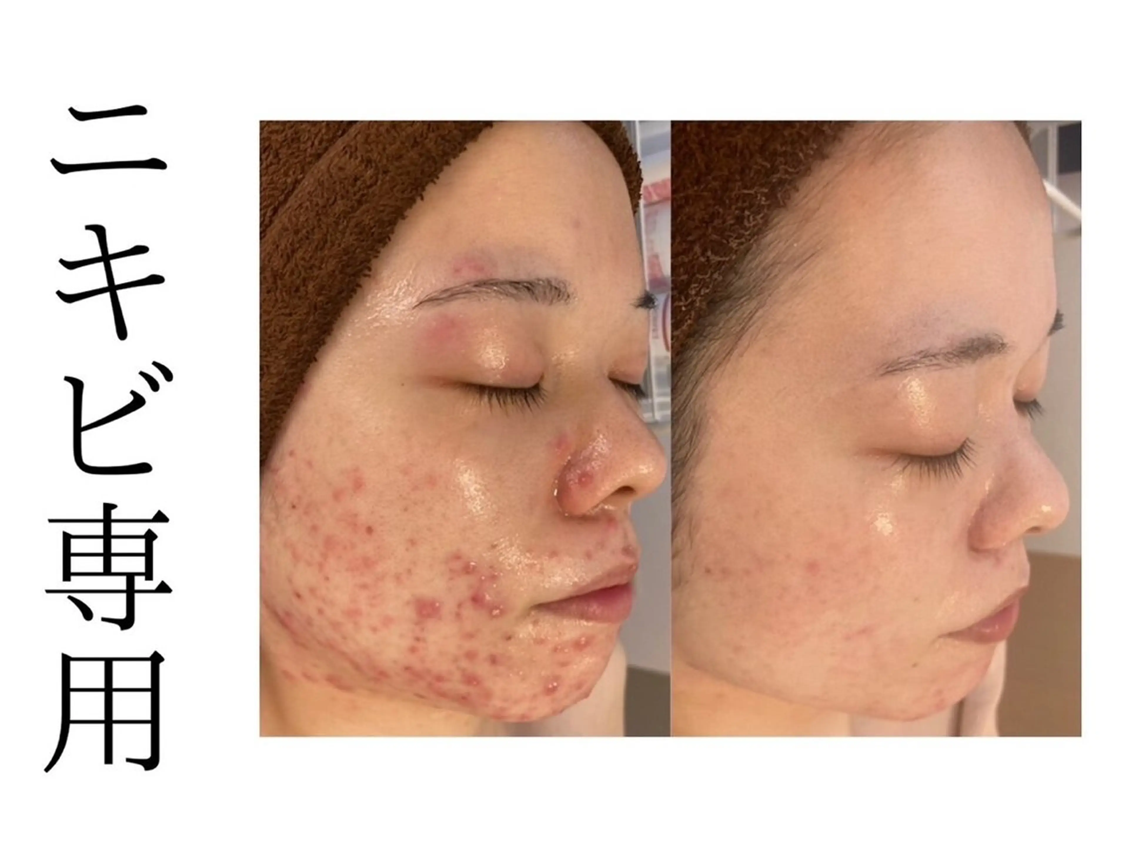 【ハーブピーリング/毛穴洗浄】NA skin 川崎店〜ニキビ・毛穴専門店〜所属・NAskin川崎 皆川のエステ・リラクイメージ