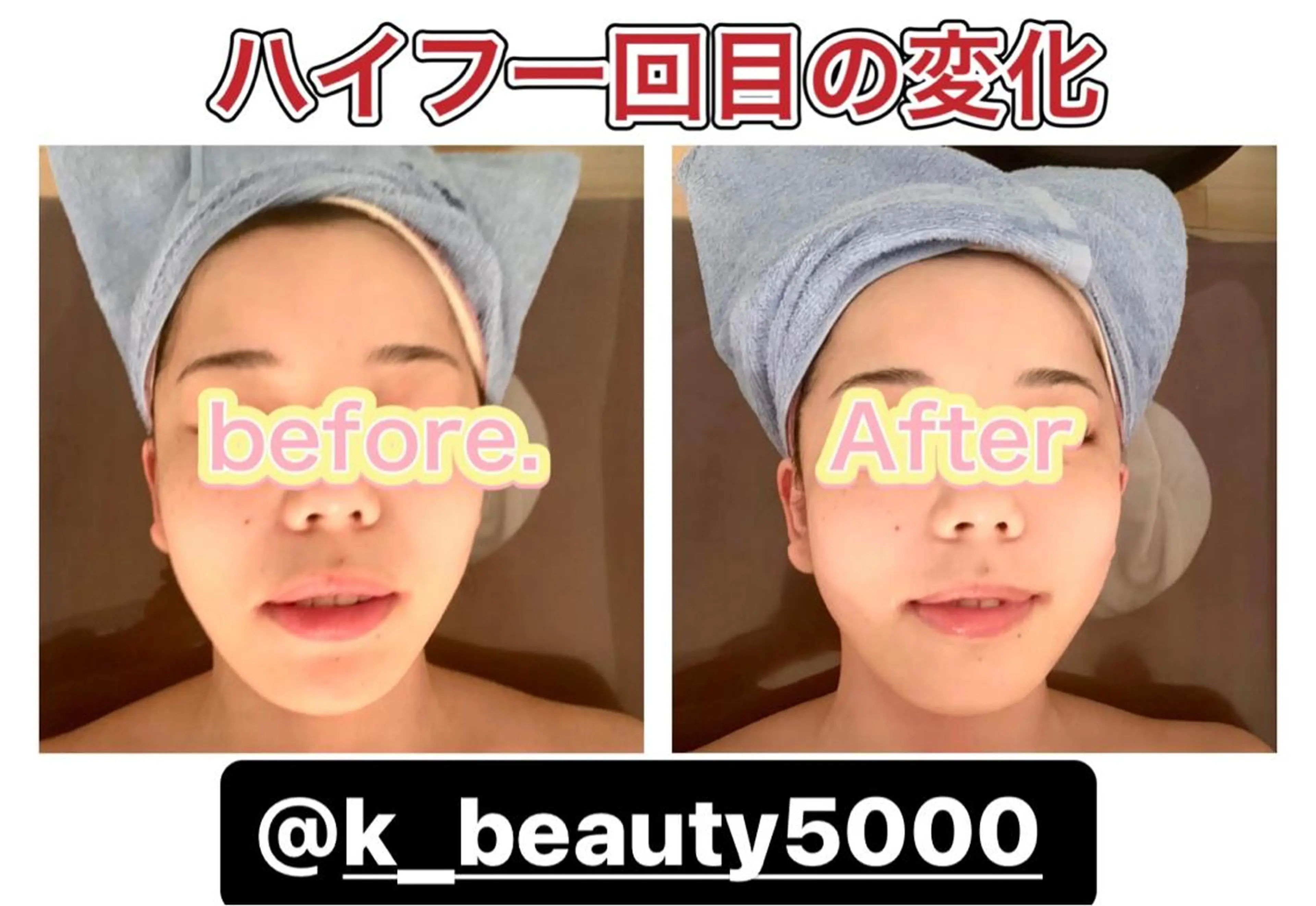 【ハイパーナイフ痩身&小顔コルギ&ハーブピーリング】K-Beauty　東新宿所属・kーbeauty小顔 コルギ&インディバのエステ・リラクイメージ