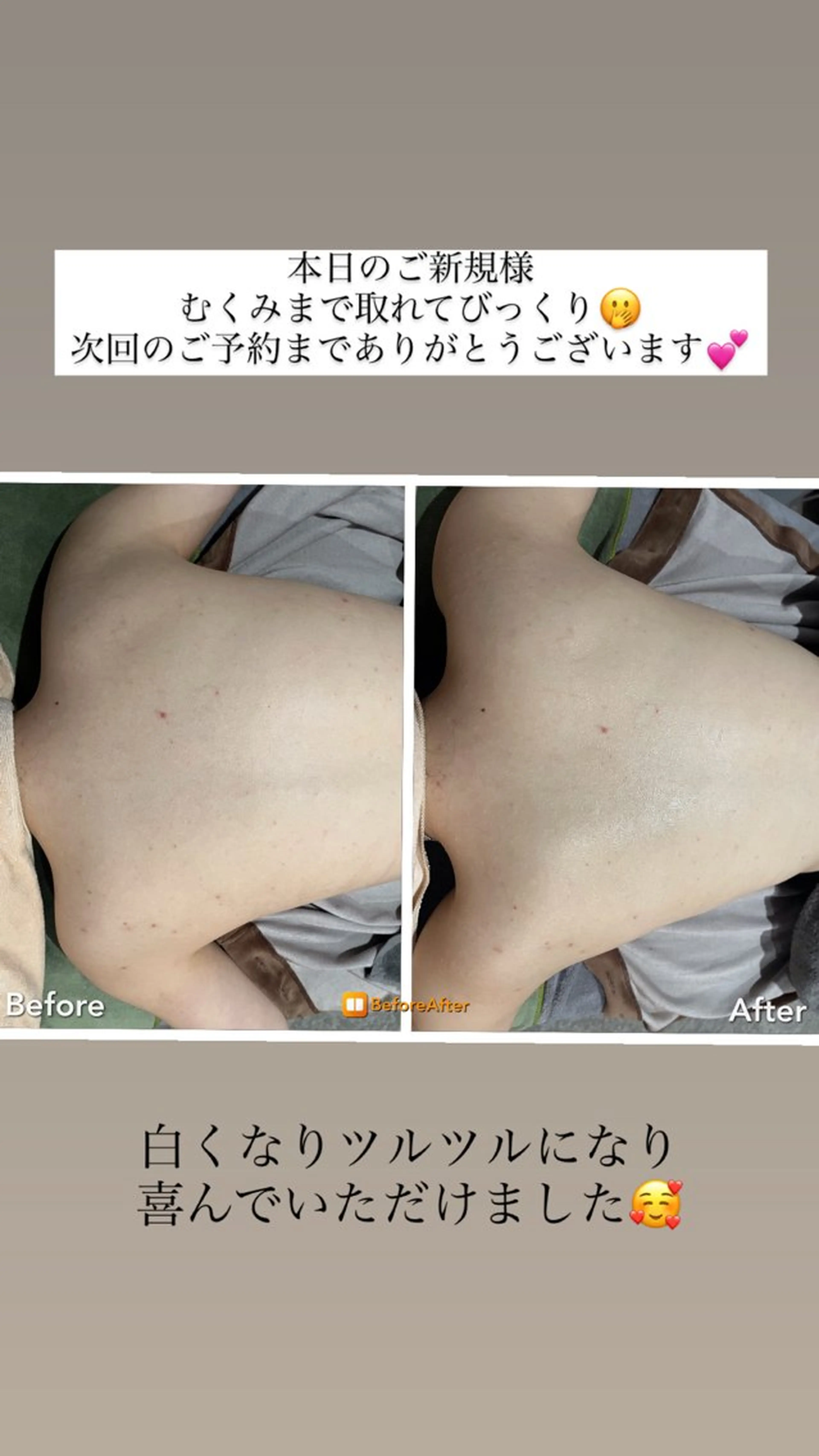 Meupニキビ専門店 背中/ハーブ/ララのその他イメージ