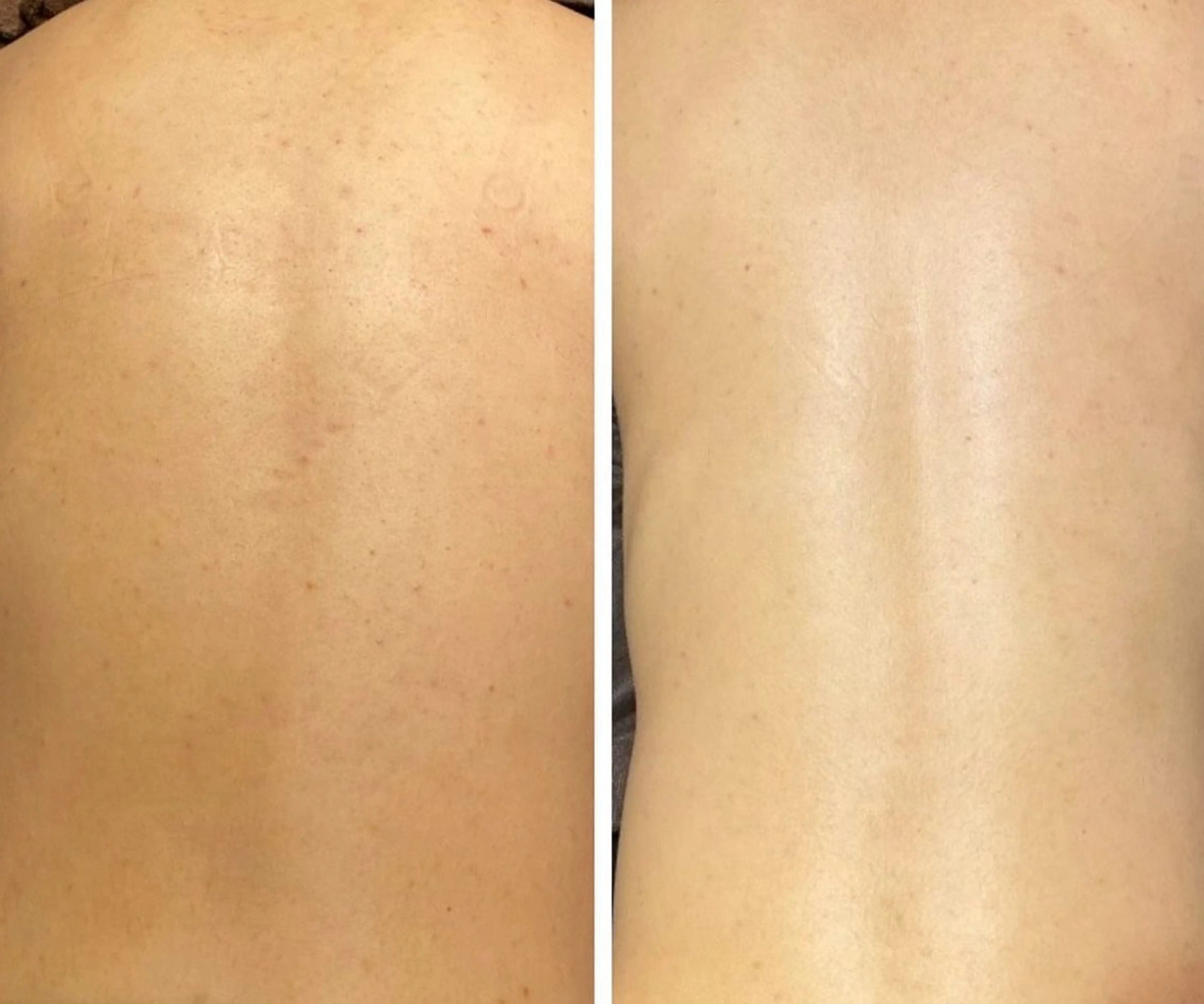 ハーブピーリング🌿ヒップの写真