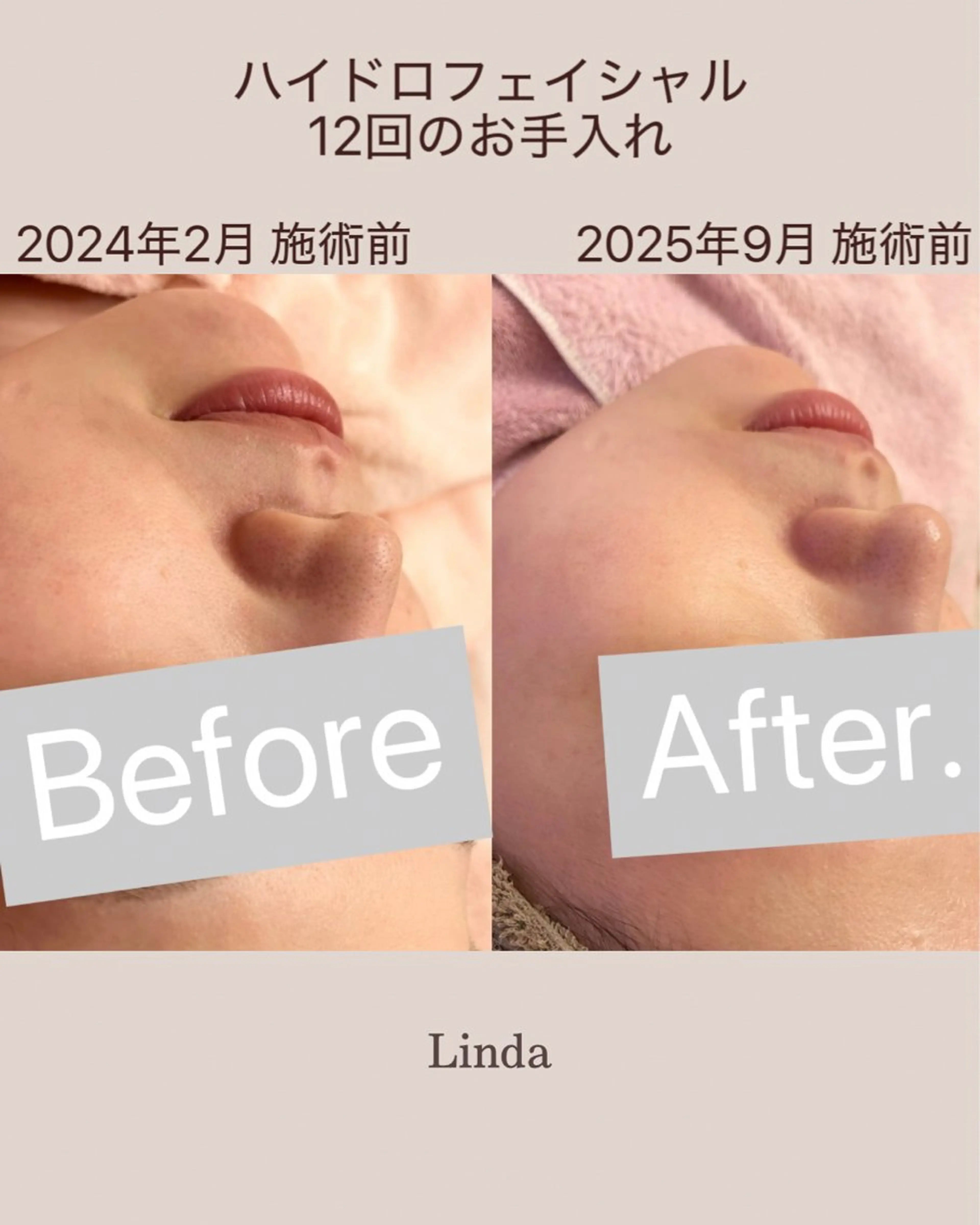 エステ アイラッシュ&エステサロンLinda西宮所属・小顔&肌質改善 LINDA西宮 AIのエステ・リラクイメージ