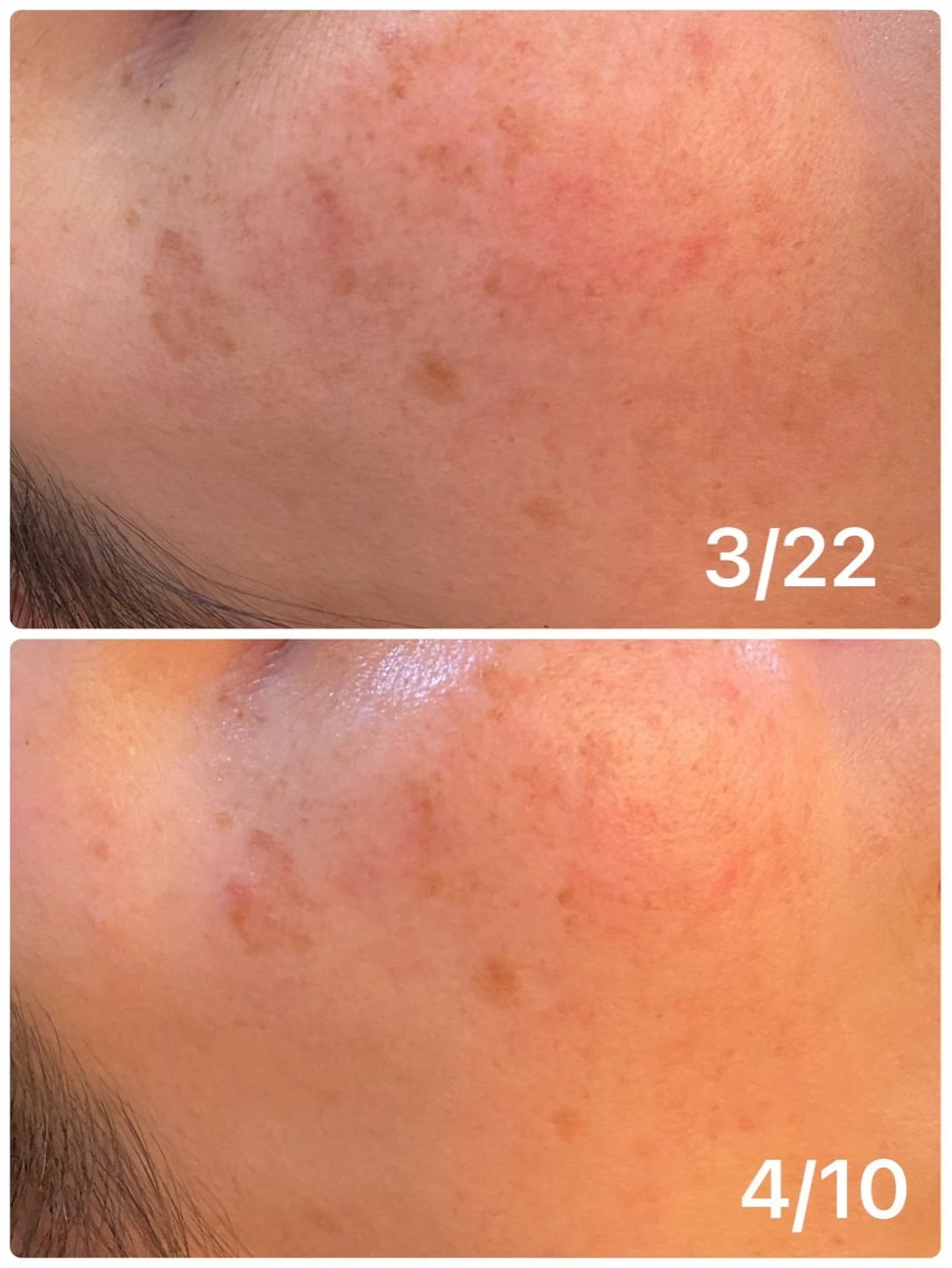 ⛄️白雪肌ホワイトスノーピール⛄️シミシワ、お肌の色むら毛穴もついでに撲滅させたい方必見‼️の写真