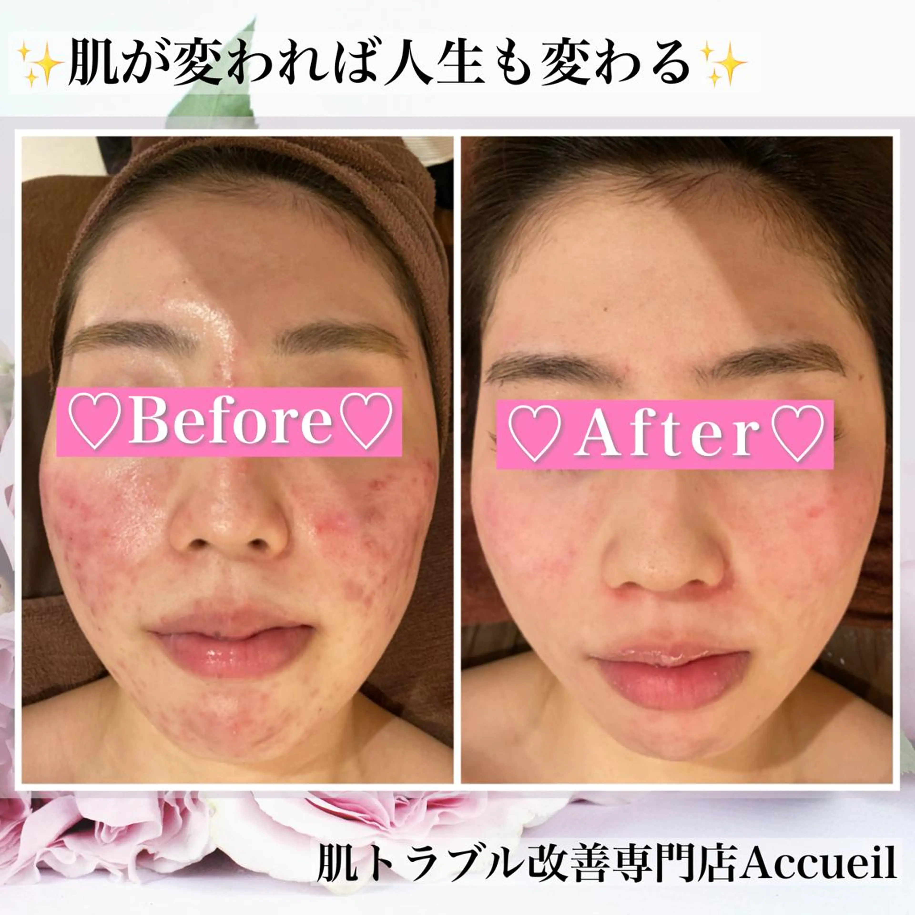 ミディアム カラー パーマ ヘアアレンジ メンズ キッズ ネイル マツエク・マツパ アイブロウ エステ リラク アクール　齋藤 ♡肌トラブル卒業のエステ・リラクイメージ