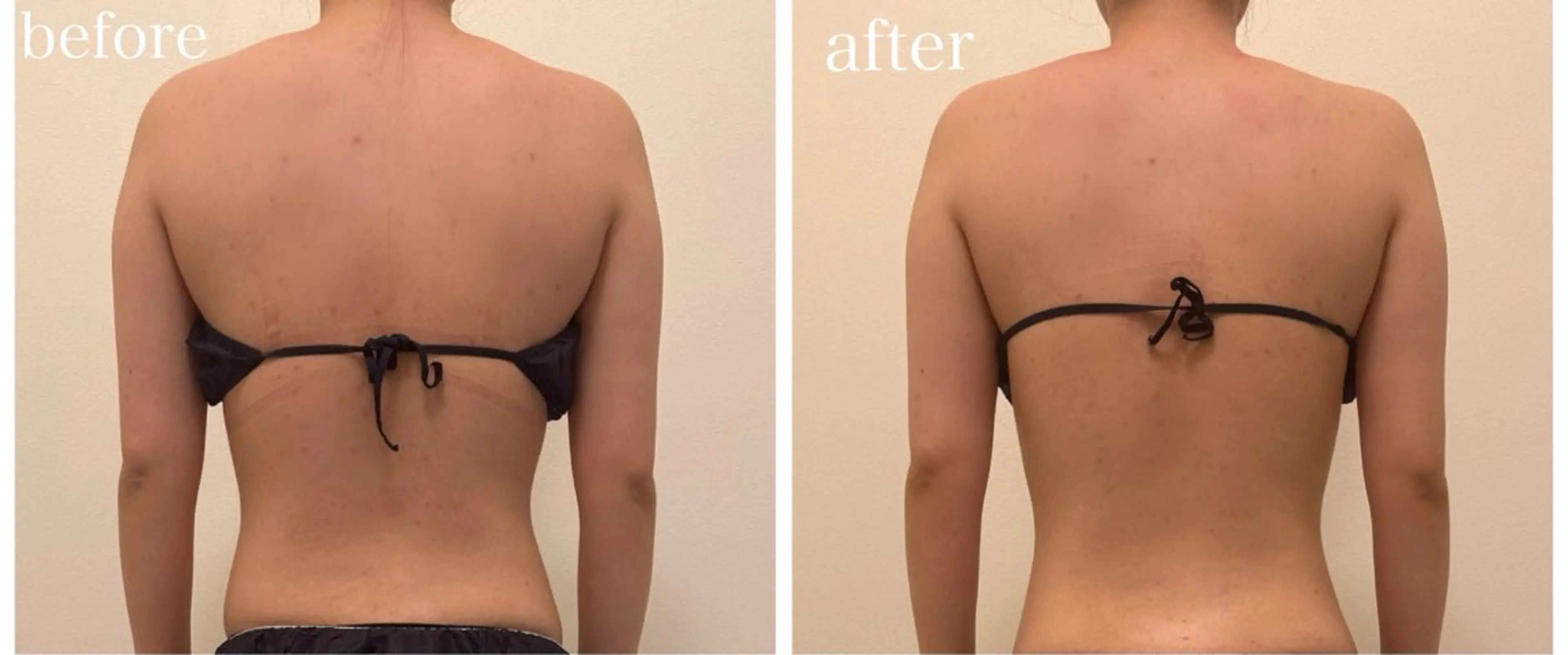 【5名様限定】ブライダルの方にオススメ！ハイパーナイフお背中・二の腕集中20分の写真