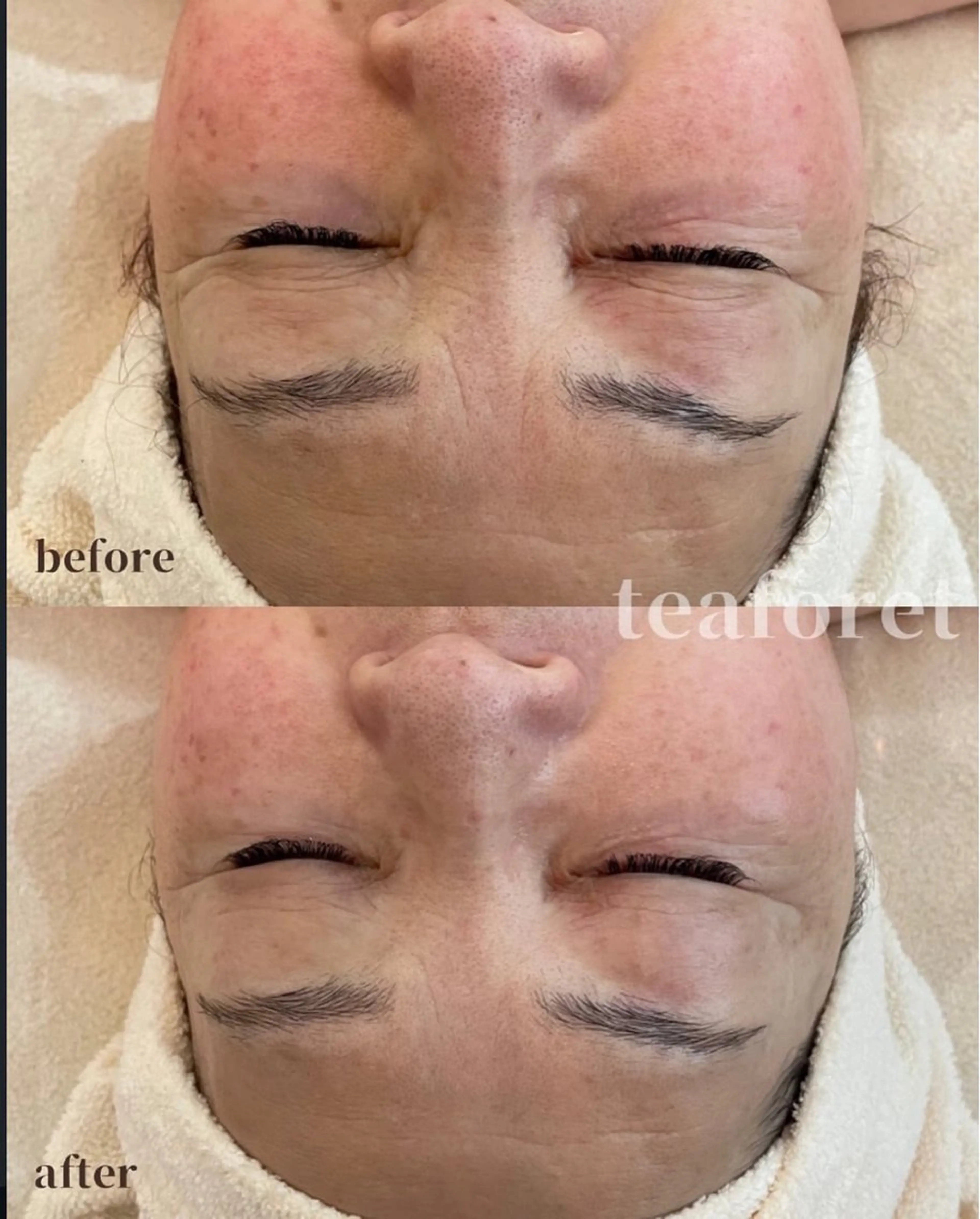 【11月限定✨】超音波洗浄サービス❗️肩甲骨剥がし+シワふっくらコースの写真