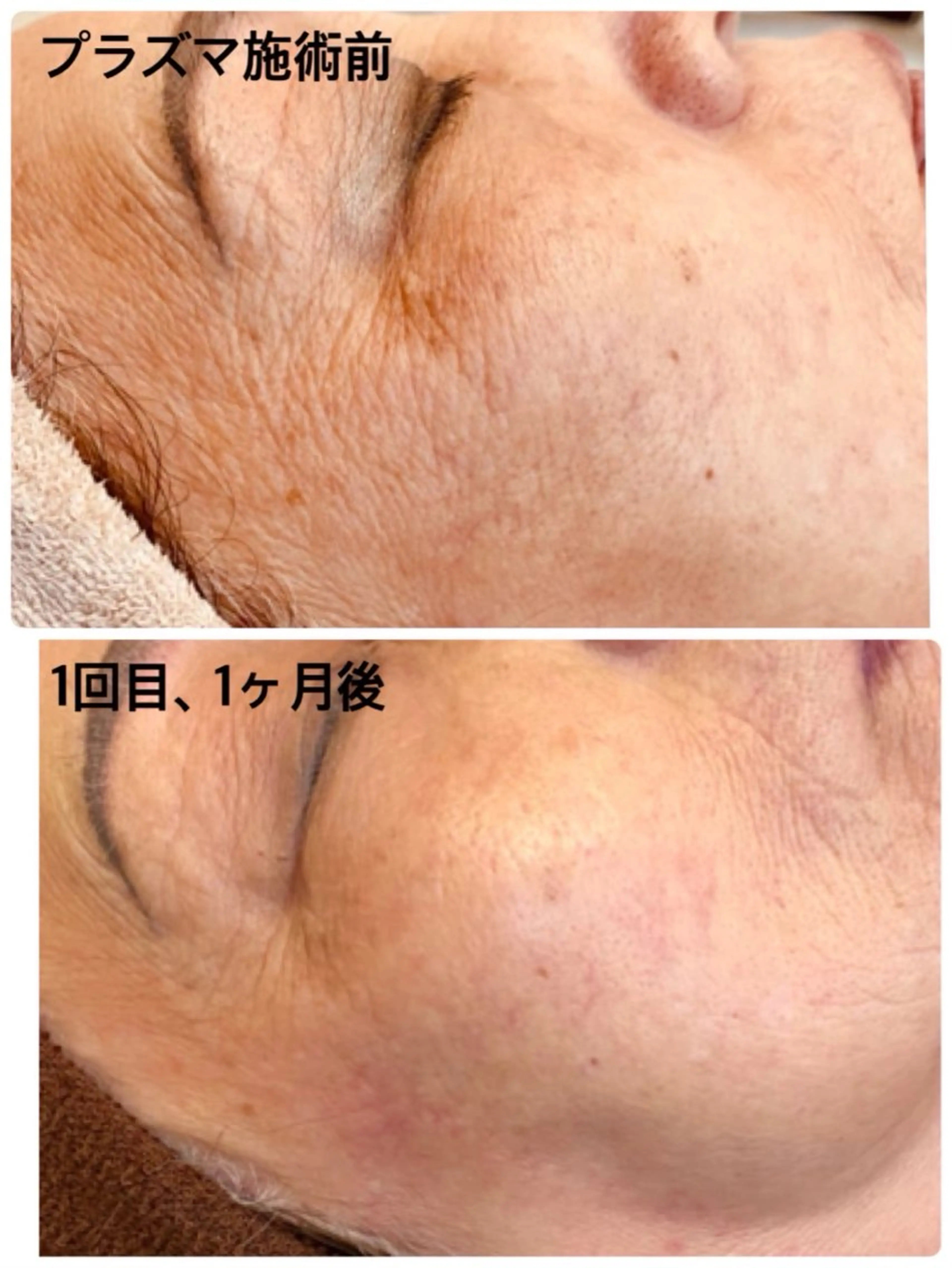 【 最先端美容 】プラズマシャワー  導入美容液１種込み ￥13,200 → ￥5,500の写真