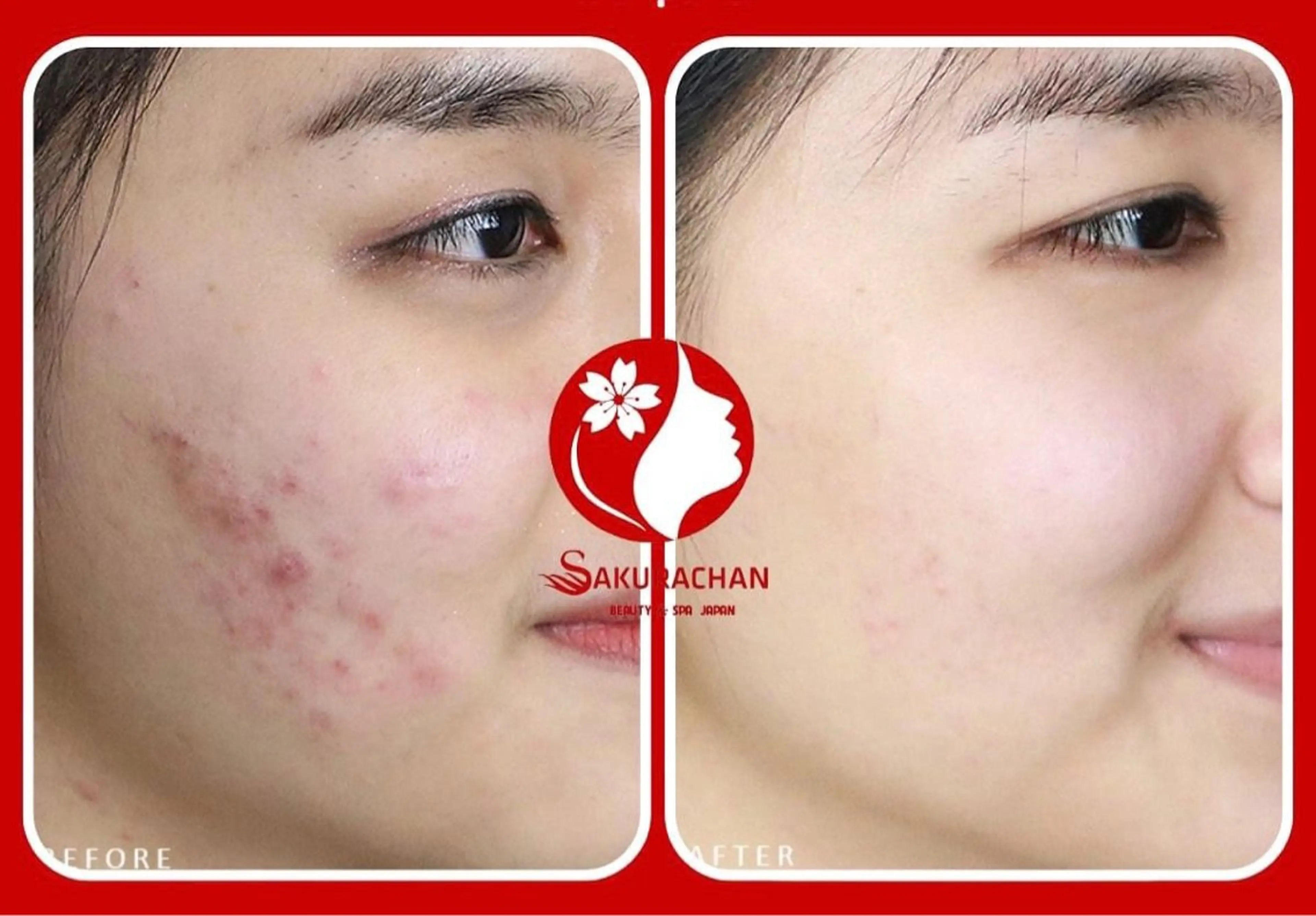 ニキビ、痩身、脱毛、 サクラチャンスパのエステ・リラクイメージ
