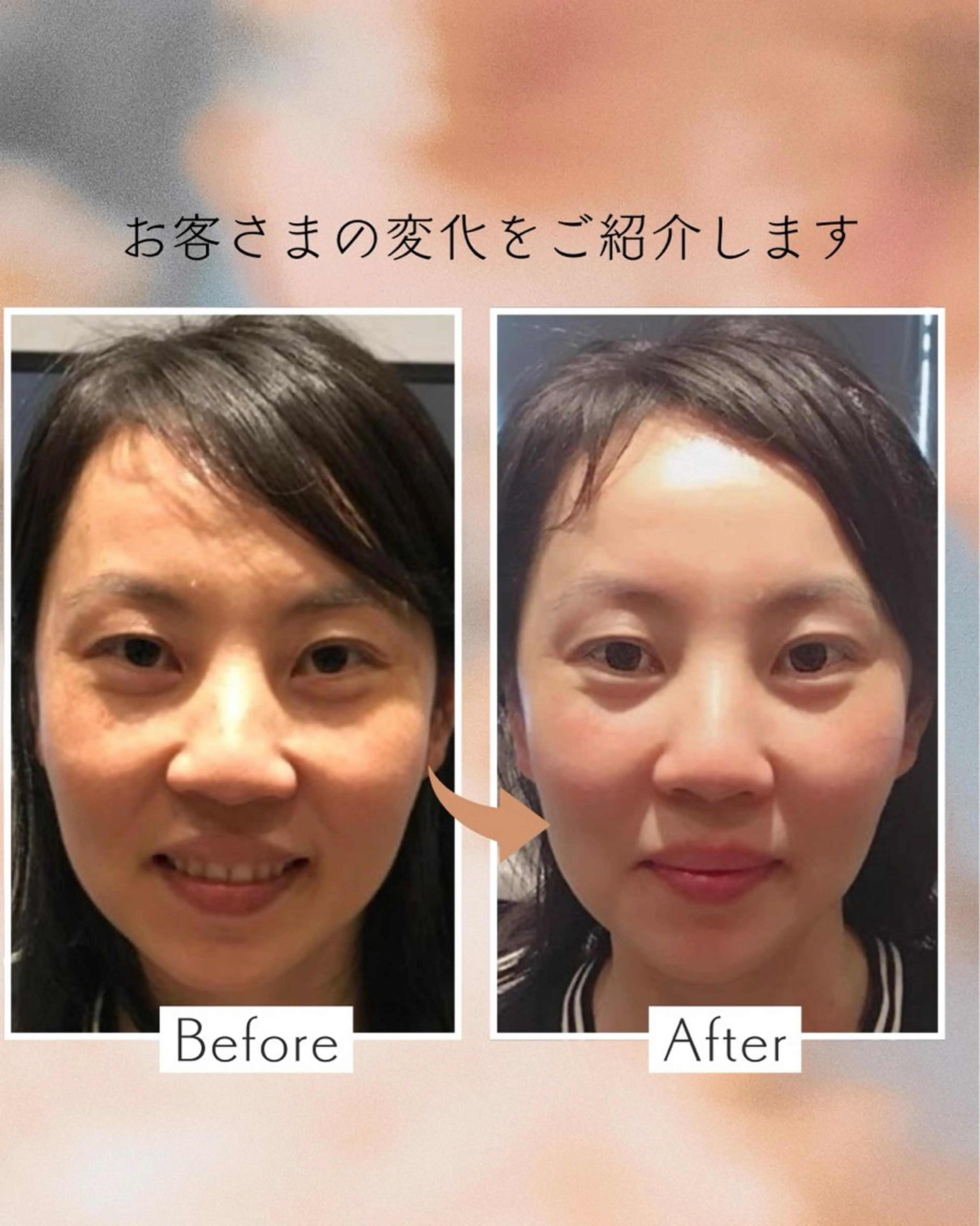 ミニモ限定❤️サクッと小顔💆♀️ヒト幹細胞小顔コルギ🩷estherヒト幹細胞エッセンスたっぷり浸透させるよ🧴の写真