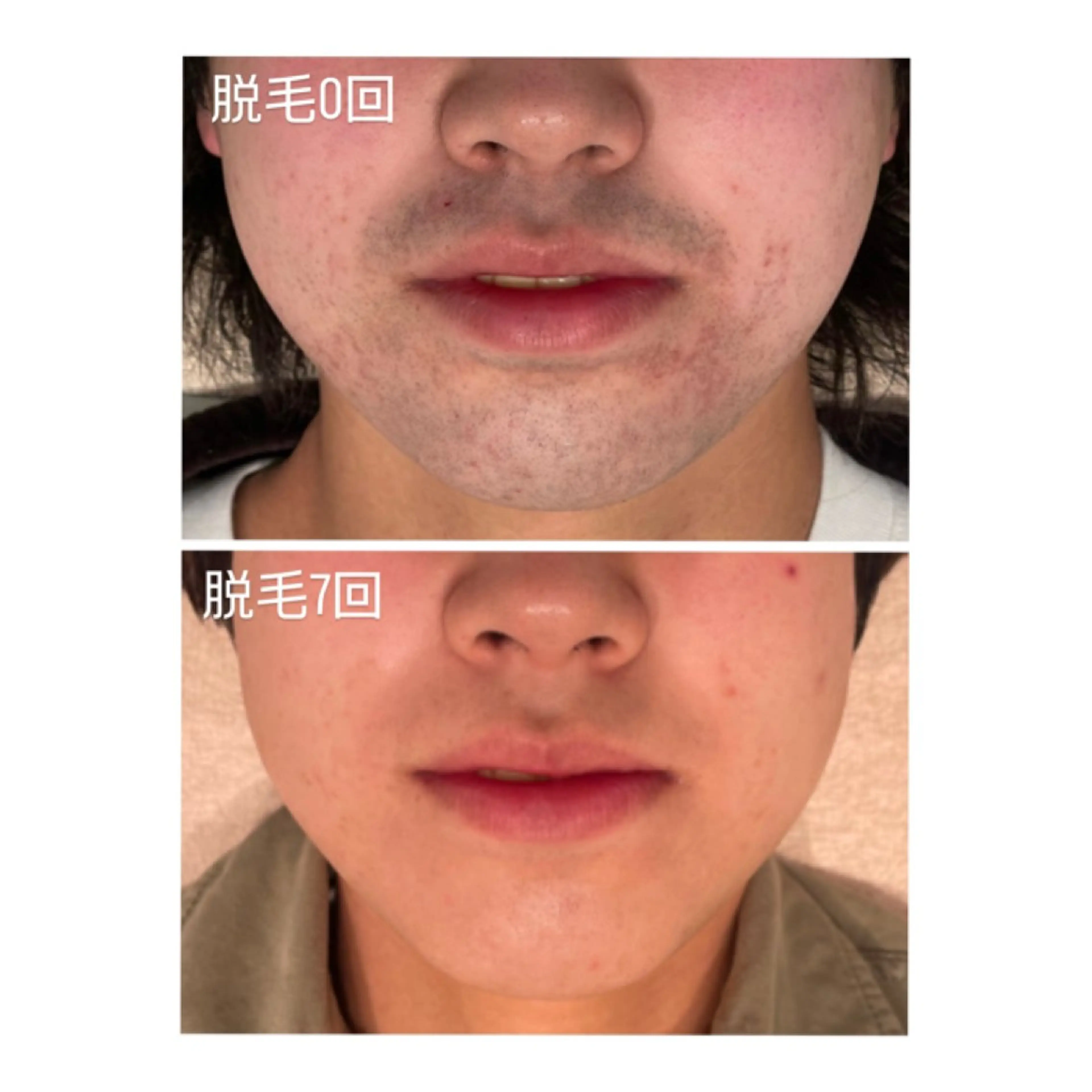 脱毛 TotalBeautySalon UNCHEL所属・Ito ayakaのその他イメージ