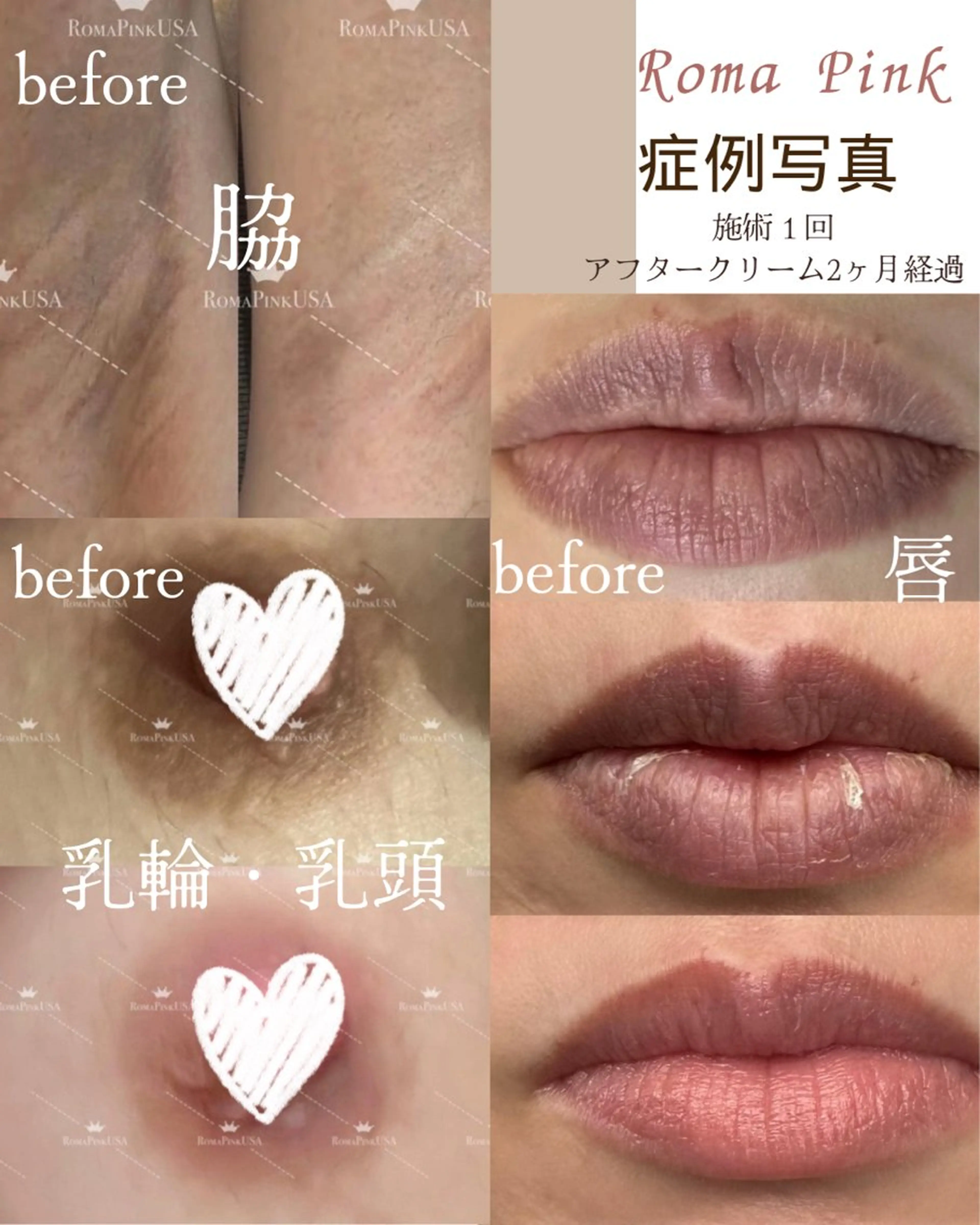 話題の最新黒ずみ除去【ローマピンク】　　　　　　　　       無料カウンセリング￥0の写真