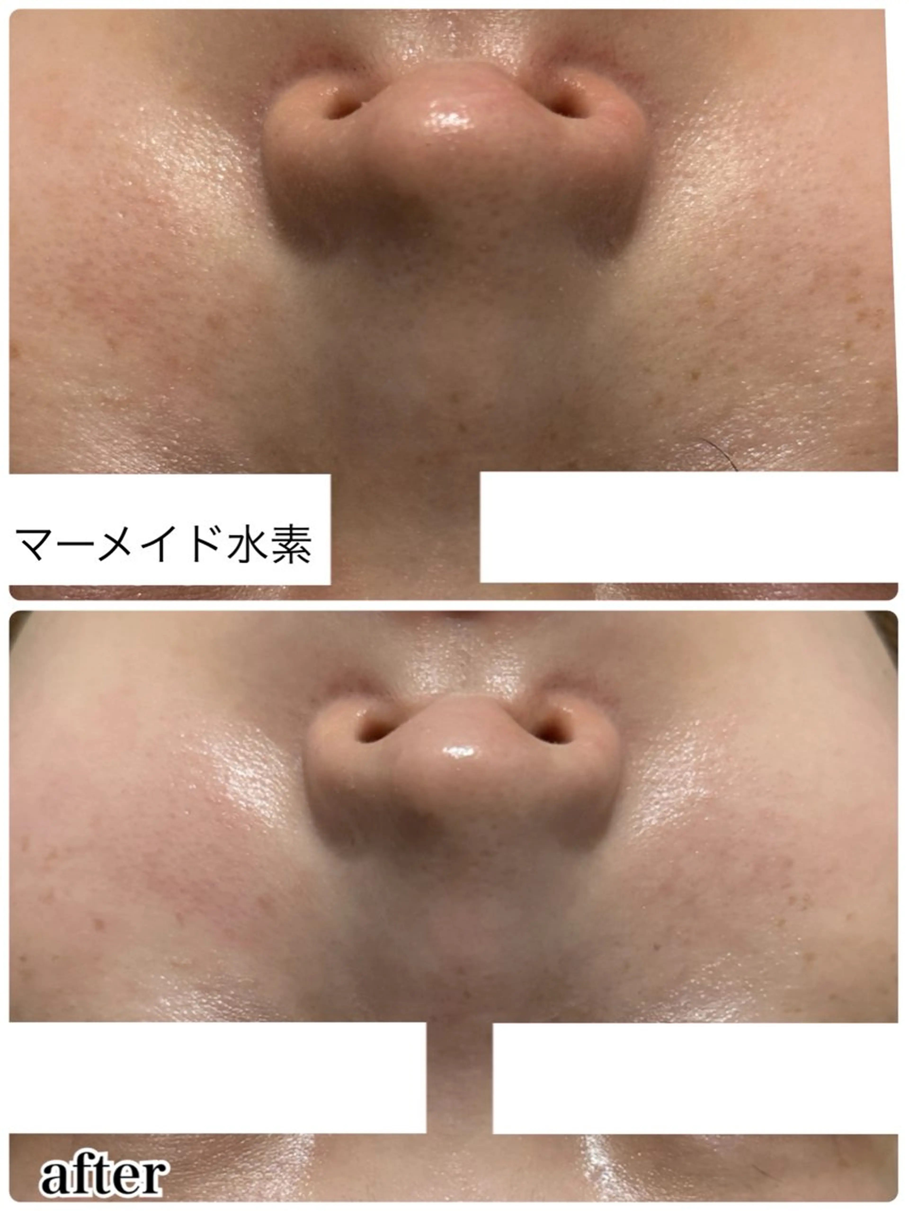 【ハリ✨キメ✨ツヤ✨水光肌】マーメイド水素トリートメント🧜♀️🫧の写真