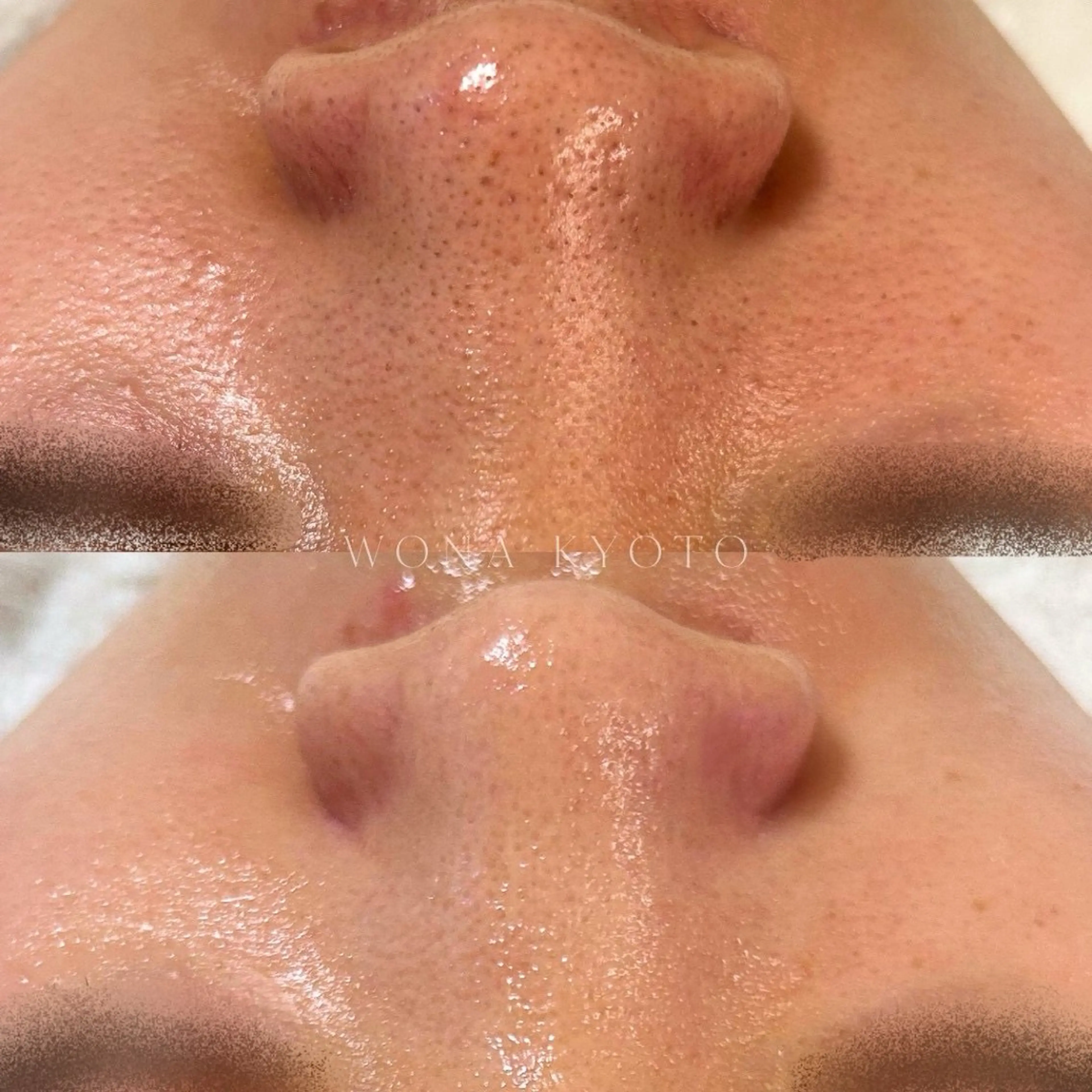 【単品】アクアピール肌管理【毛穴洗浄ピーリング】皮脂詰まり/黒ずみ/毛穴レス/ごわつき/ざらつき/くすみの写真