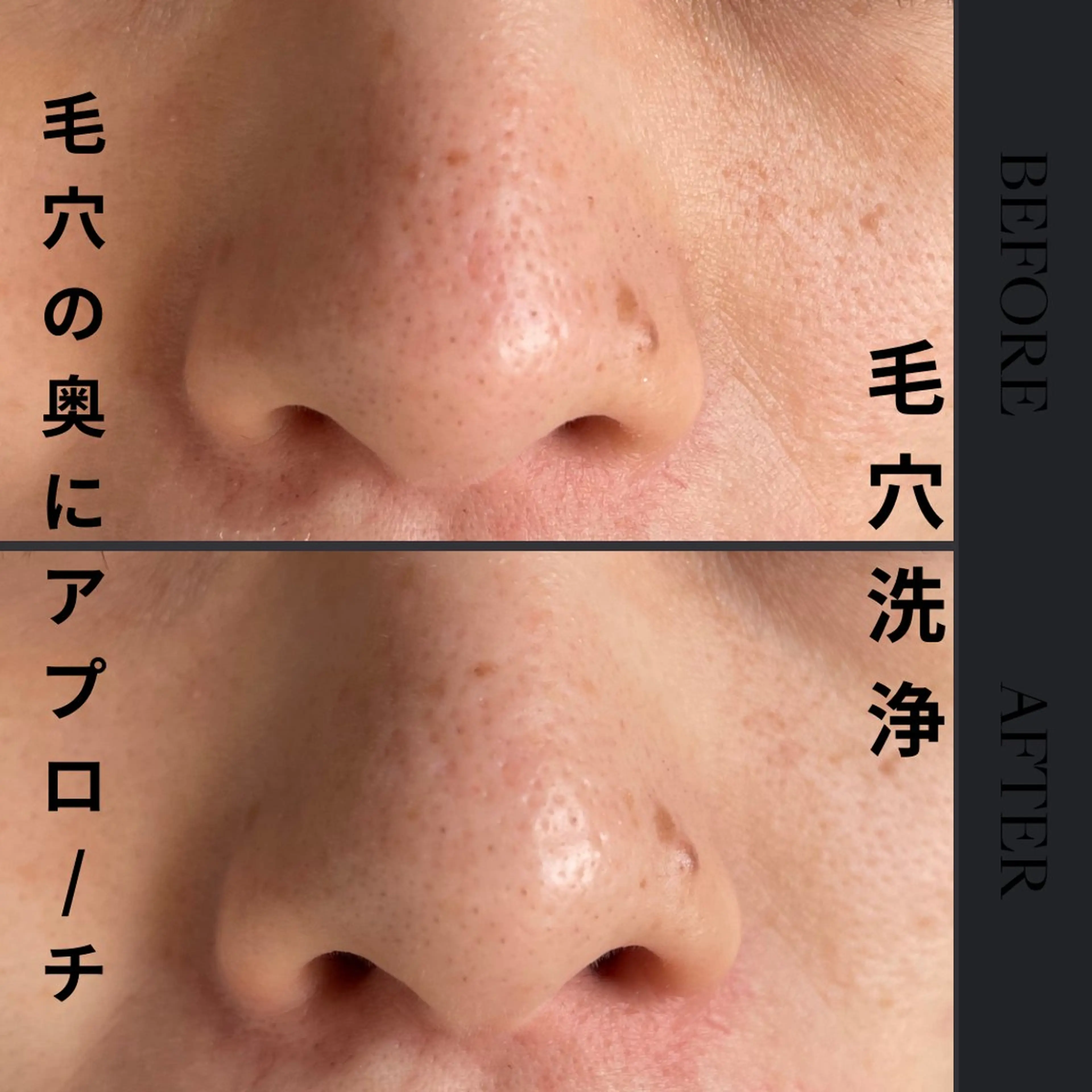 ミニモ限定価格3500円《超音波毛穴洗浄》顔全体の黒ずみ.皮脂汚れを大掃除🤍🖤お肌診断あり🖤🖤の写真