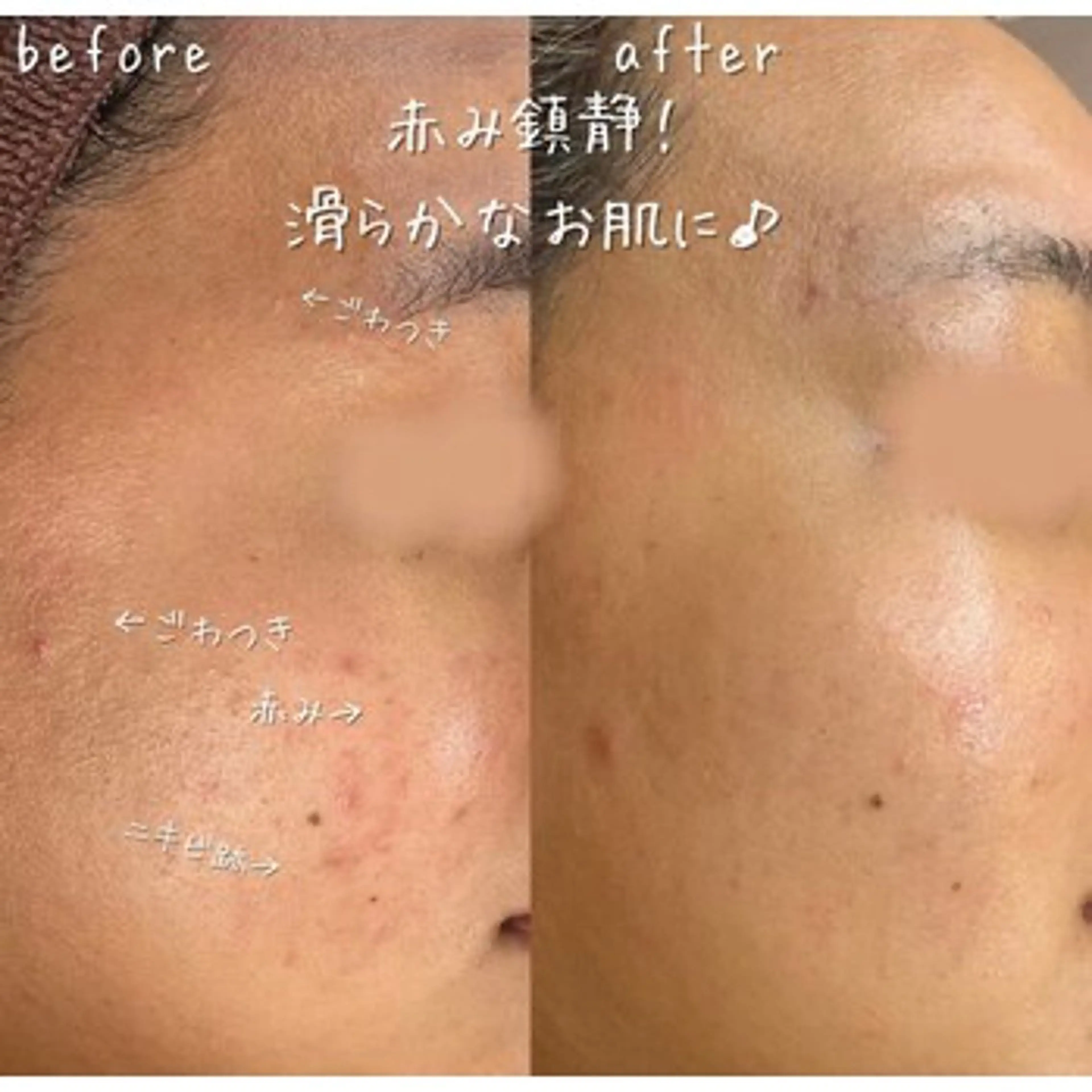 【ハーブピーリング/毛穴洗浄】NA skin 川崎店〜ニキビ・毛穴専門店〜所属・NAskin川崎 皆川のエステ・リラクイメージ