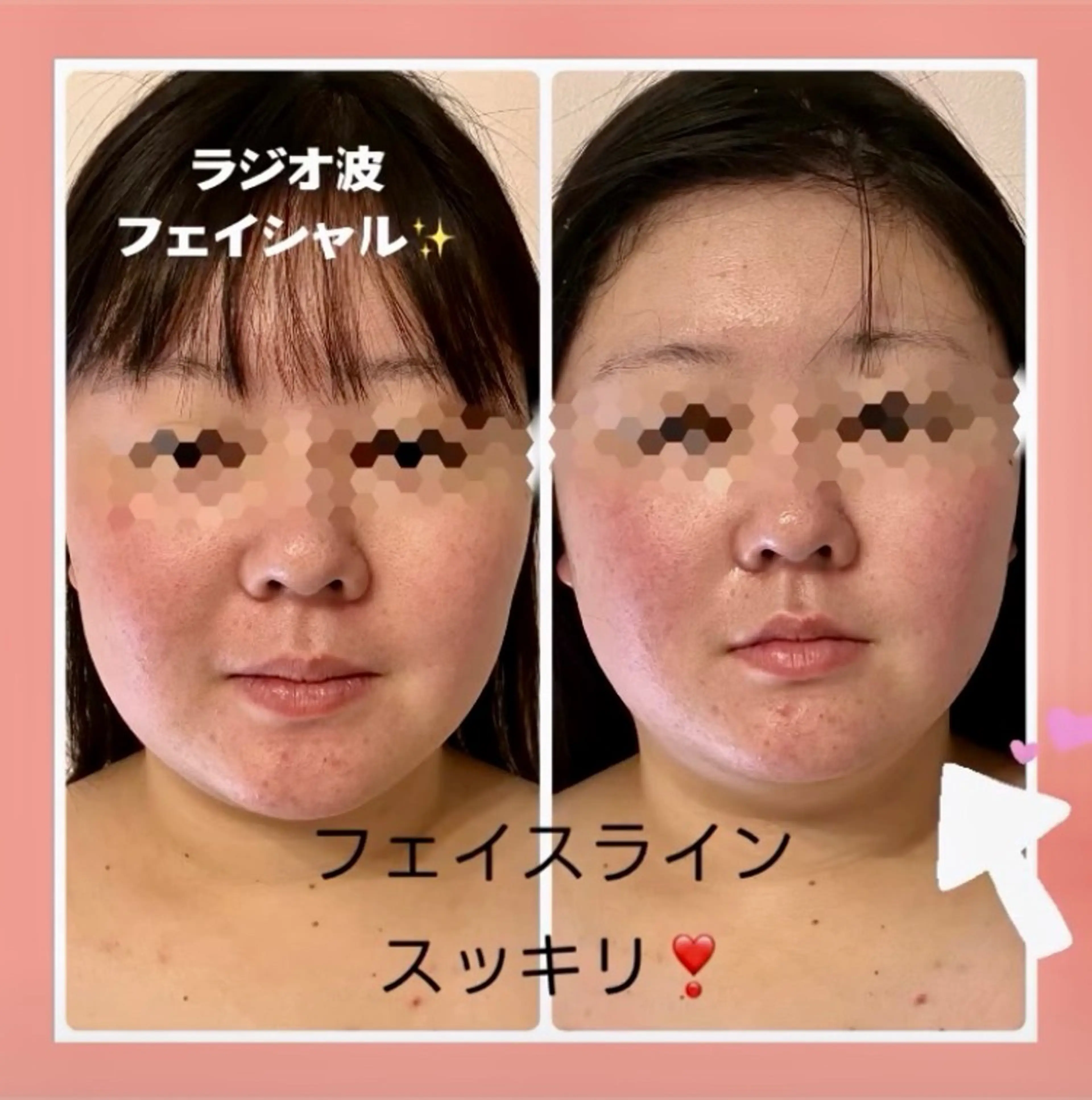 機械導入記念🎉ラジオ波フェイシャル✨小顔、ハリツヤUP✨ 通常10000円→100名様達達成するまで5000円❣️の写真