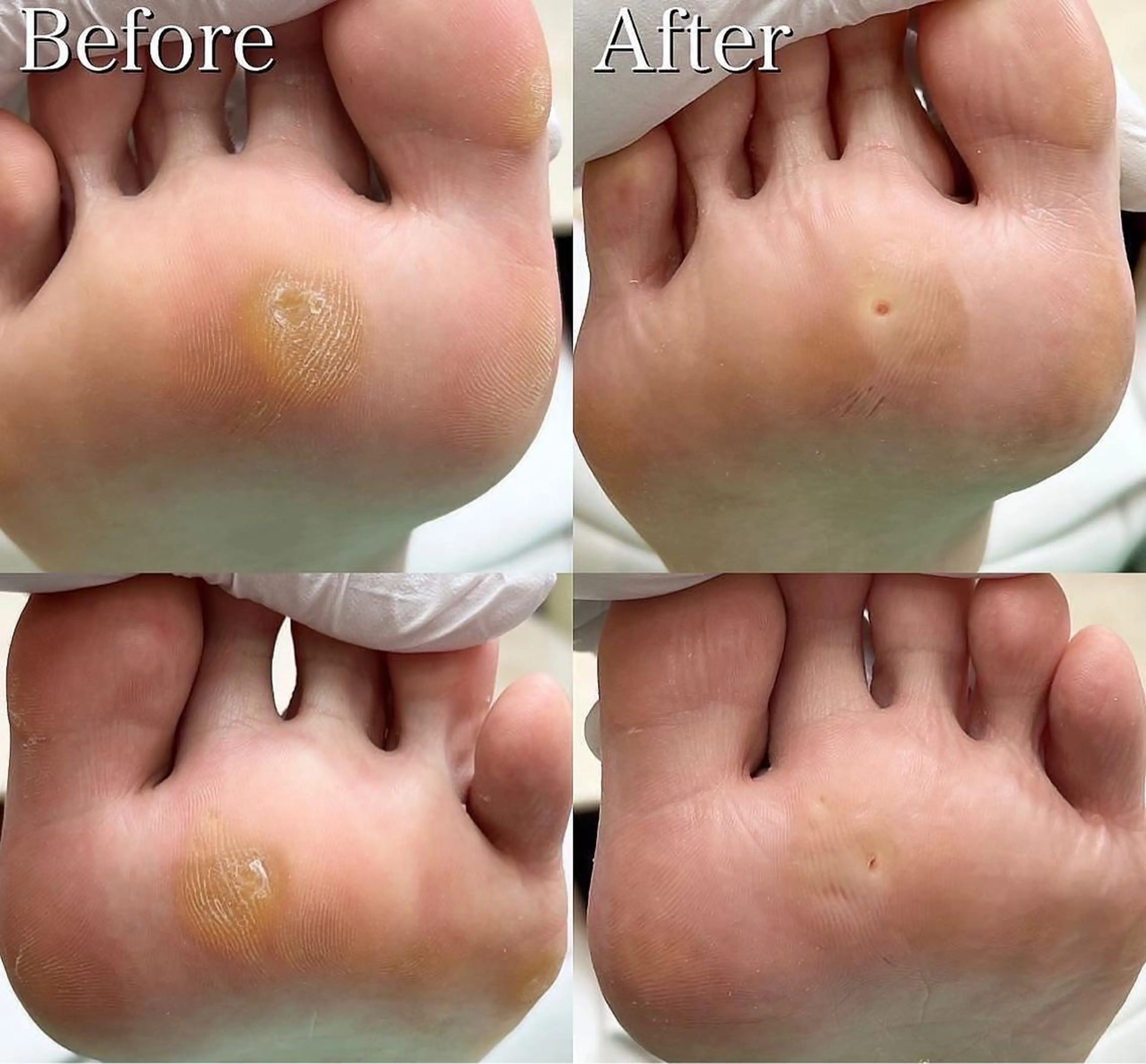 【足裏タコ魚の目ケア】足裏硬い角質もスベスベの足裏に✨魚の目も痛みが取れてスッキリ✨の写真