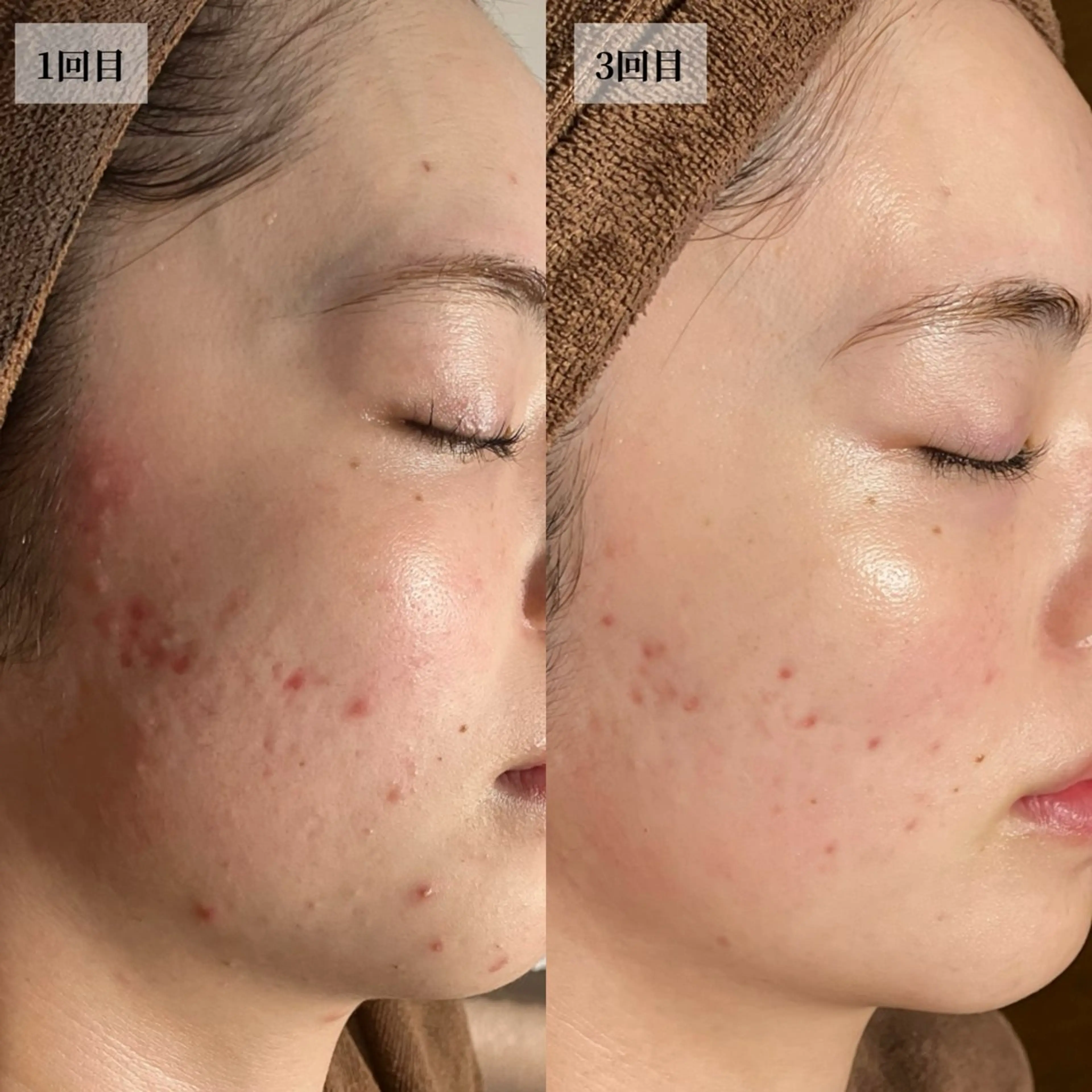 エステ HINANO矢場町店【ヒナノ】所属・脱毛/肌改善🌿 HINANO 村田のエステ・リラクイメージ