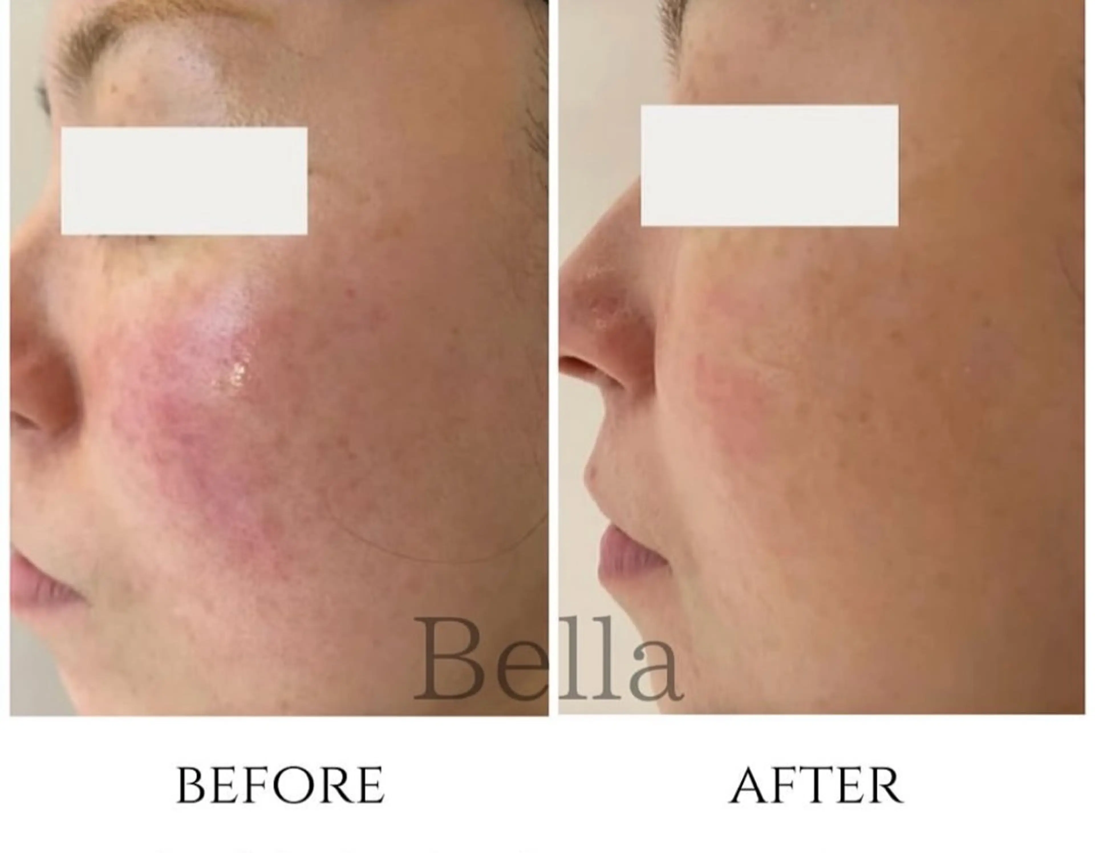 エステ 肌質改善ハーブ ピーリングBellaのエステ・リラクイメージ