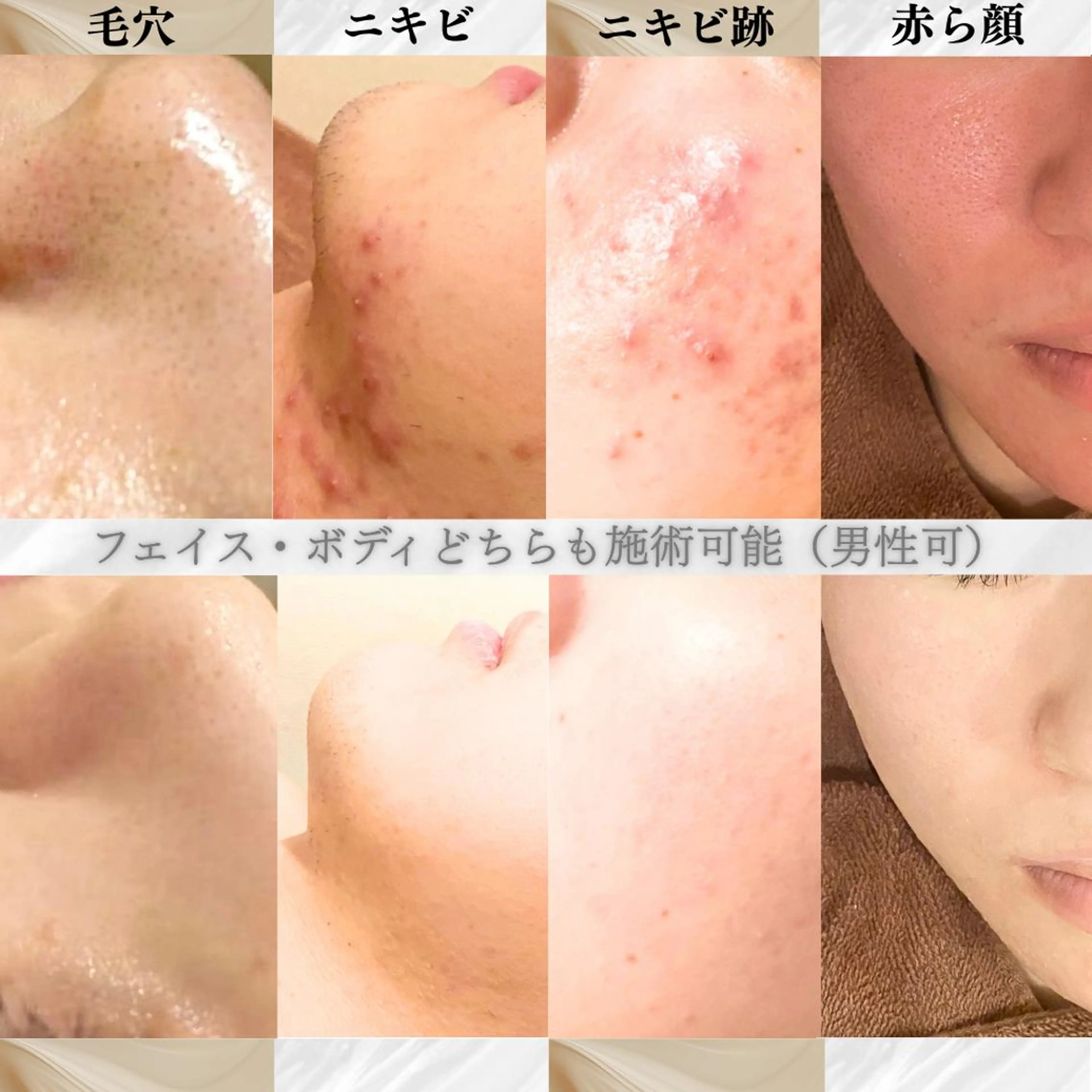 エステ リラク 実績6万人🔥 スピードニキビ改善のエステ・リラクイメージ