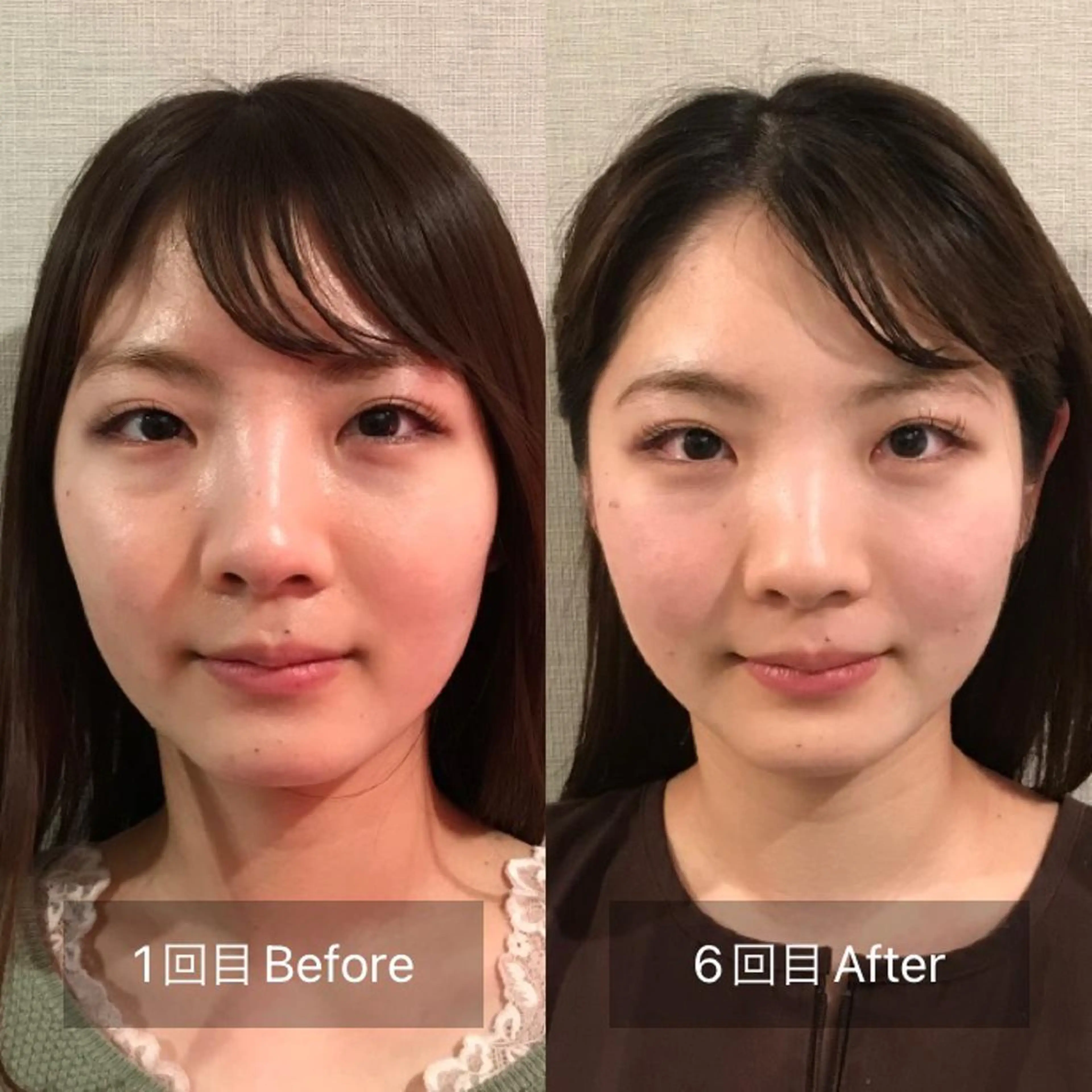 新宿hari-me所属・美容鍼hari-me 新宿のエステ・リラクイメージ