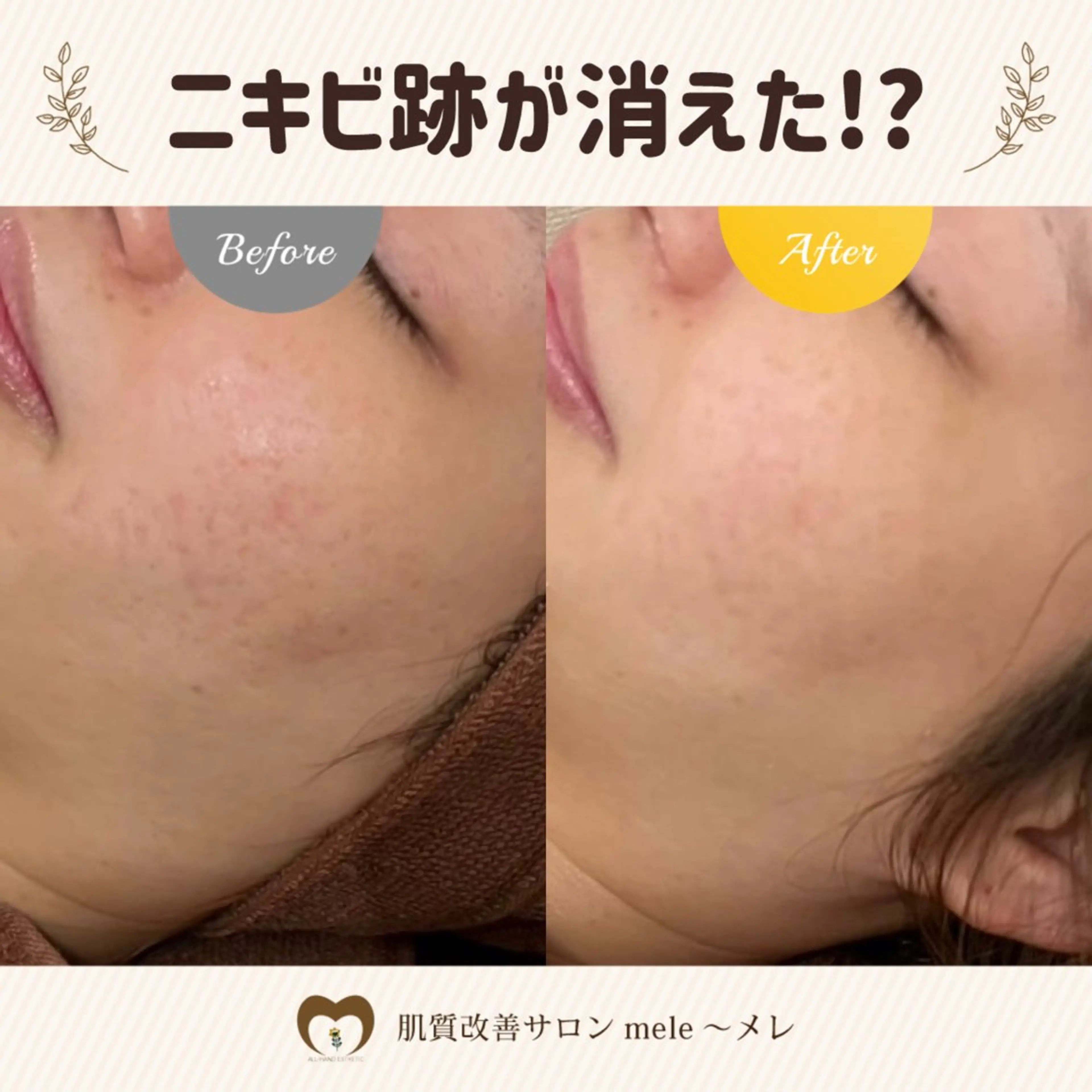 ニキビケア/毛穴/ 赤み/自信の肌✨森園のエステ・リラクイメージ