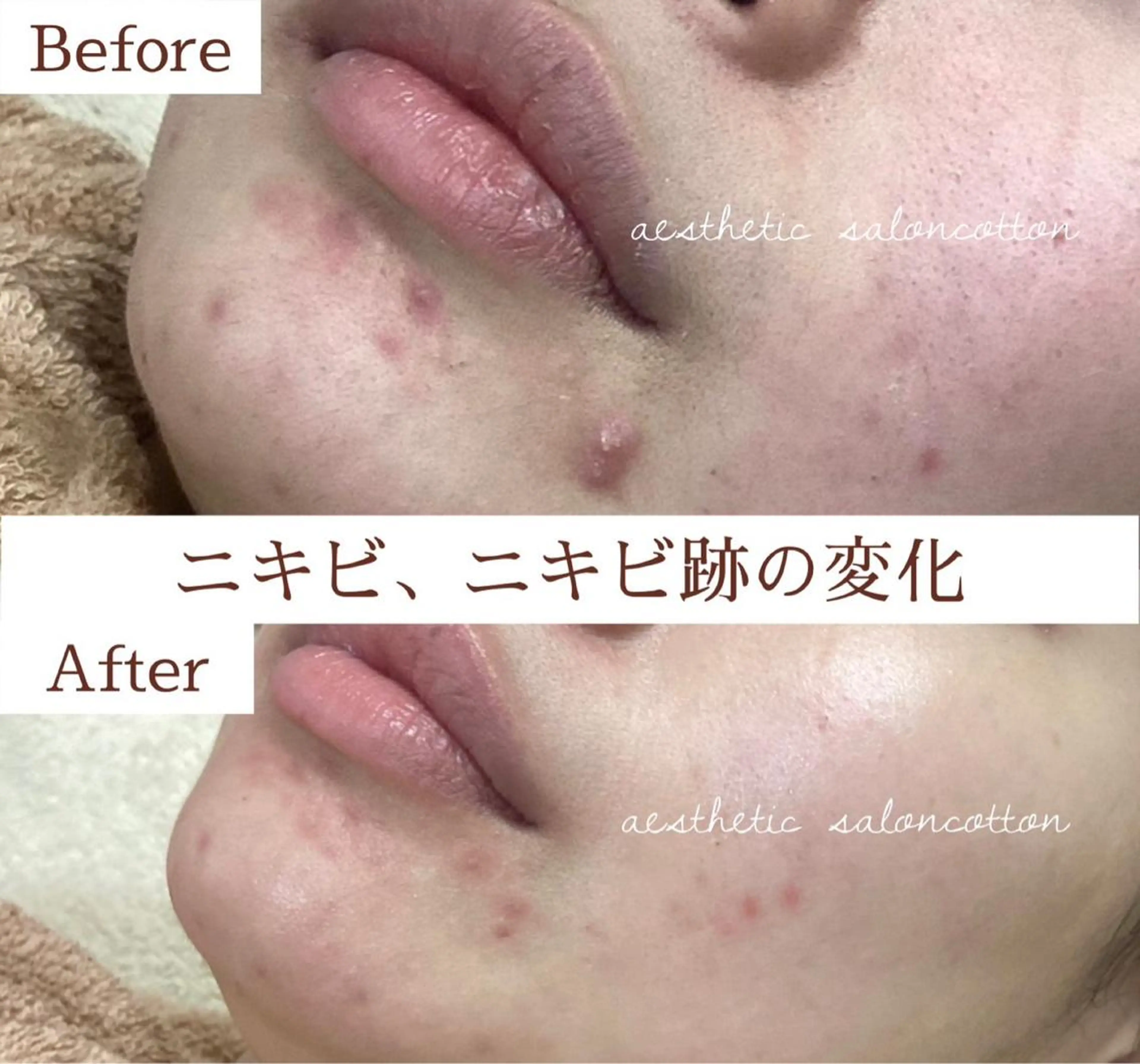 エステ 都度払い 肌質改善専門サロンのエステ・リラクイメージ