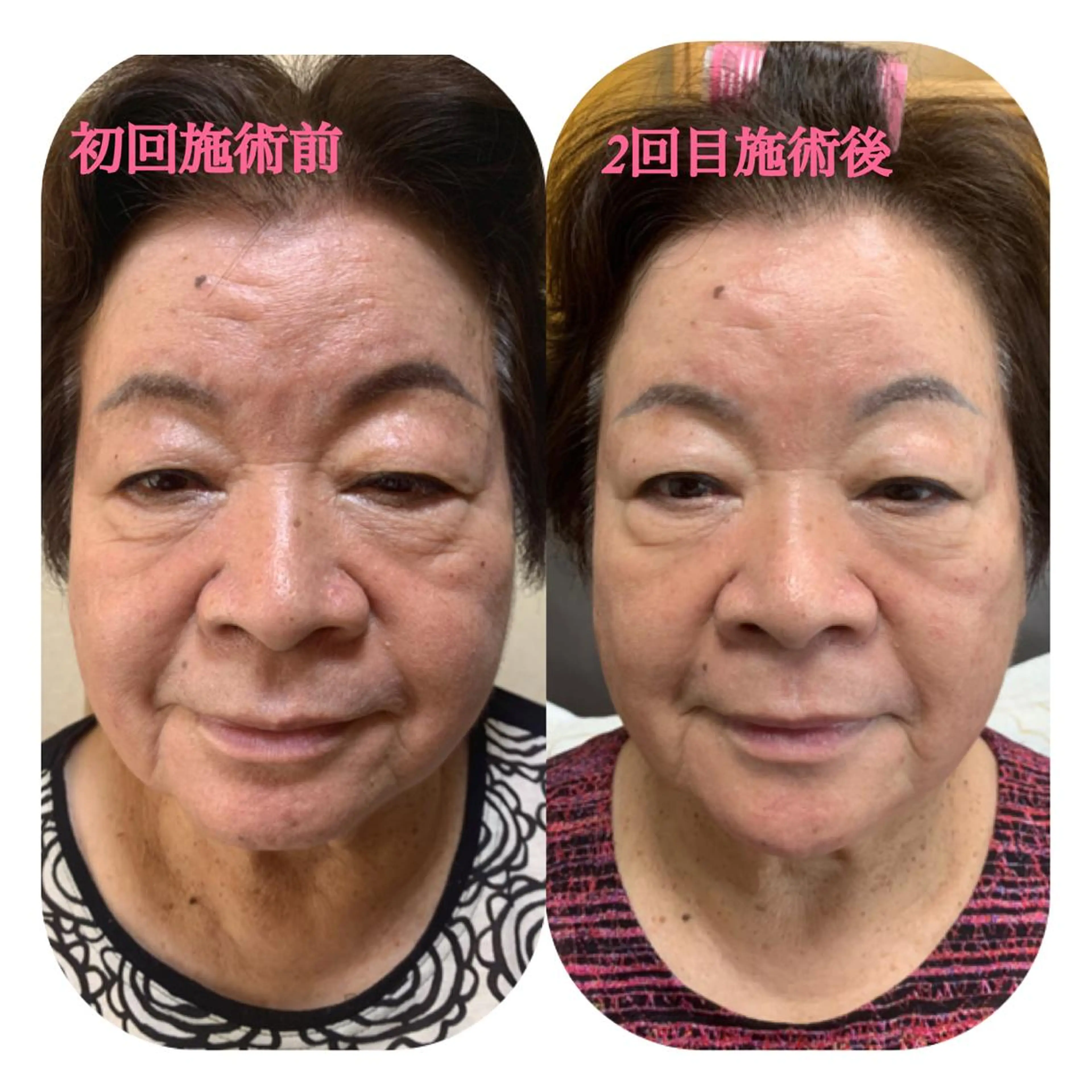 臍帯幹細胞マイクロナノニードルの写真