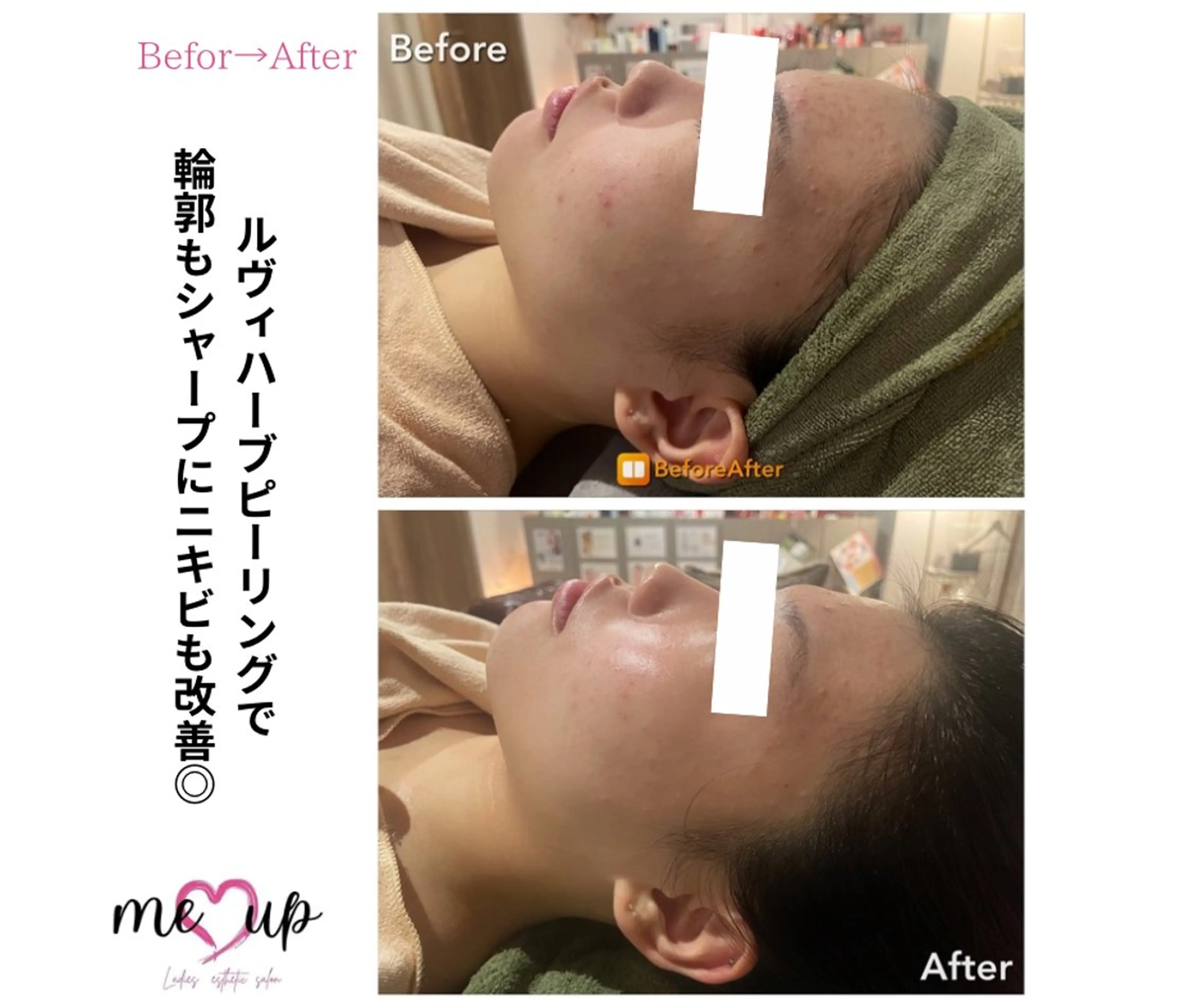 エステ Meupニキビ専門店 背中/ハーブ/ララのその他イメージ