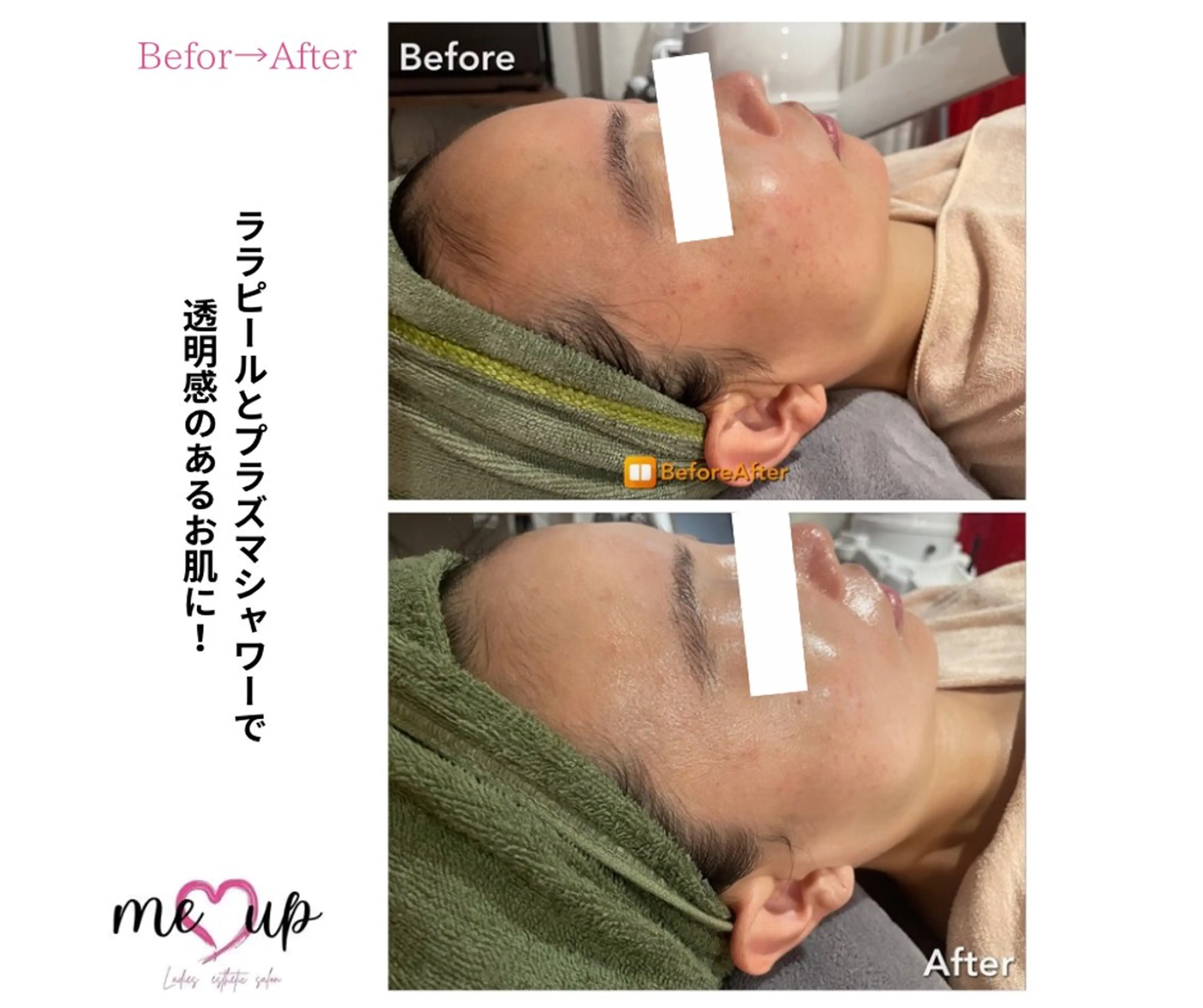 エステ Meupニキビ専門店 背中/ハーブ/ララのその他イメージ