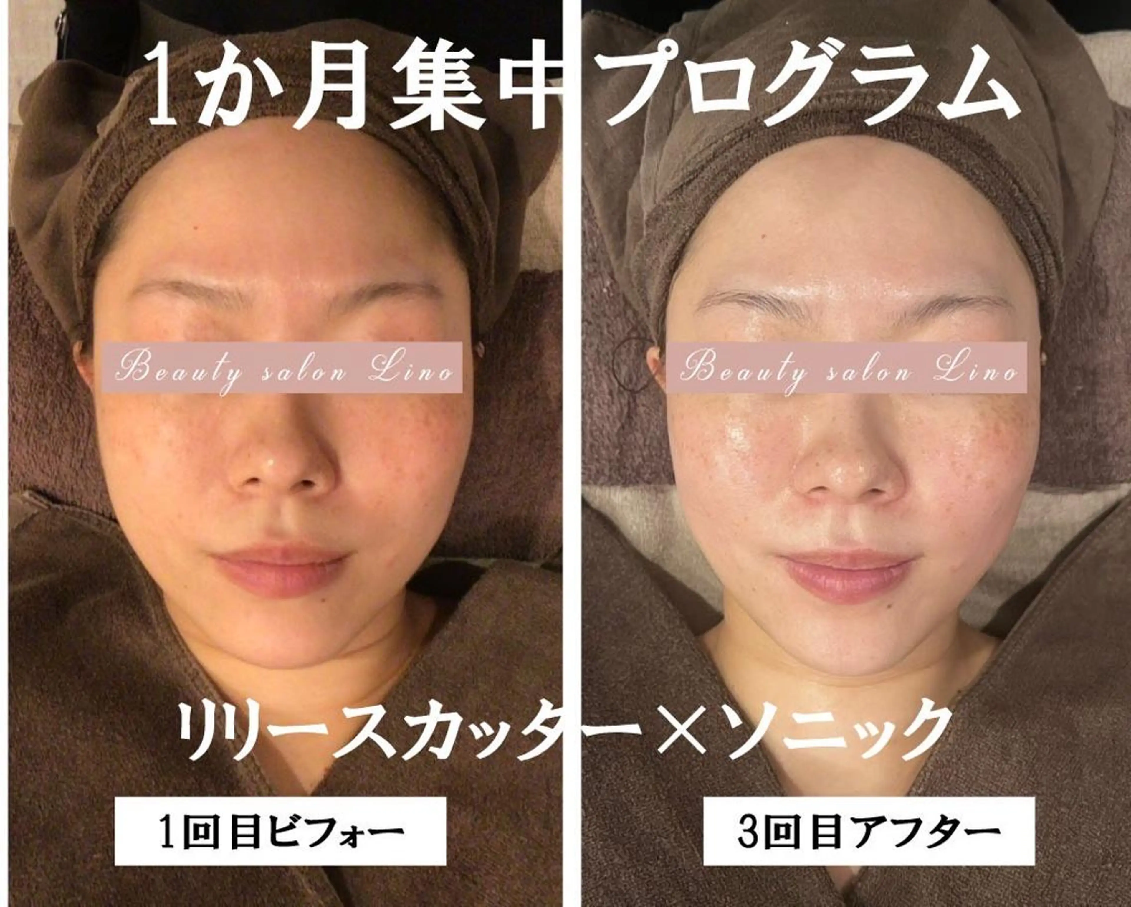 肩こり改善 筋膜リリースカッターのエステ・リラクイメージ
