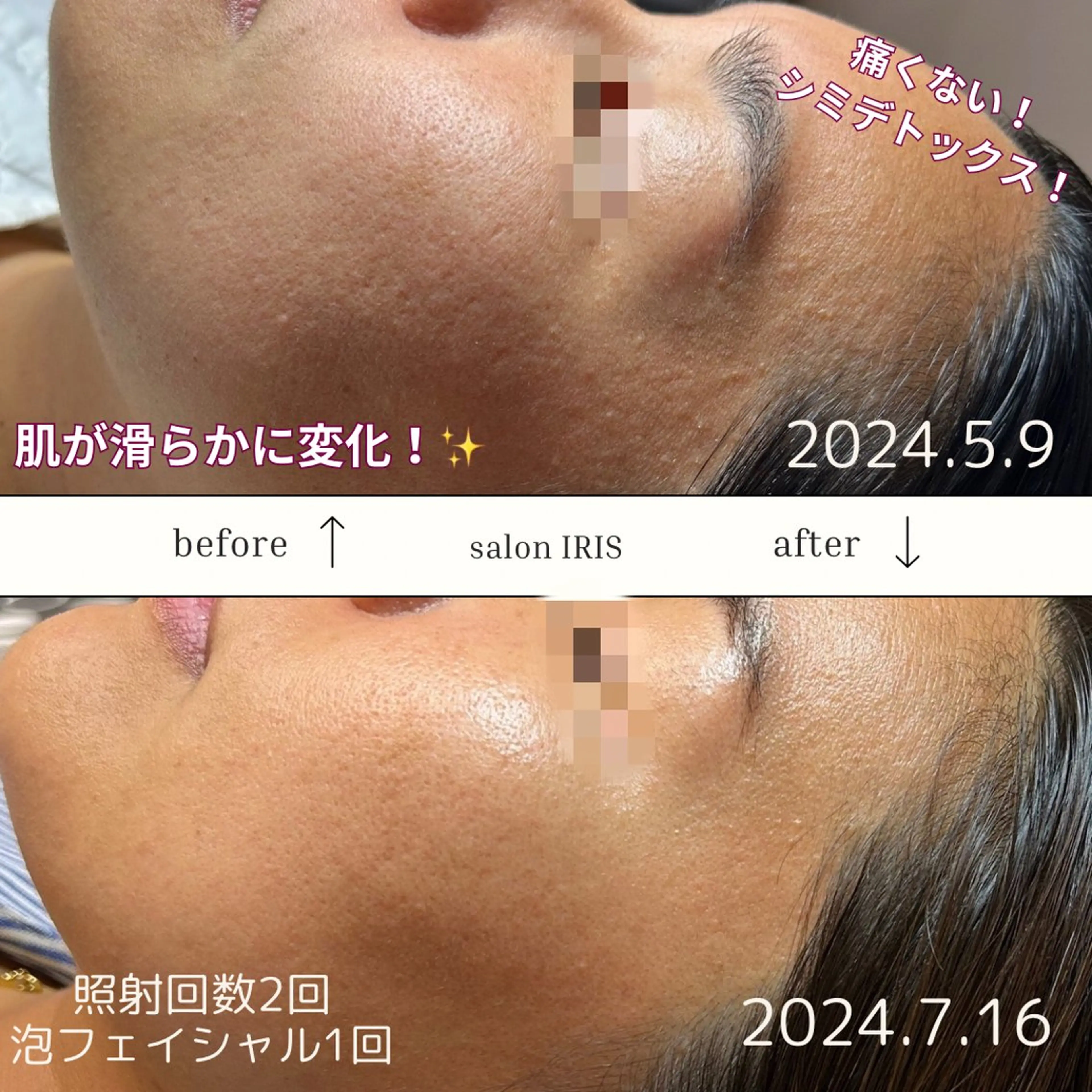 ■シミケア＆泡パックフェイシャル■泡パックし、汚れを除去！軽いピーリング効果も✨その効果によりシミケアの効果を高めます！の写真