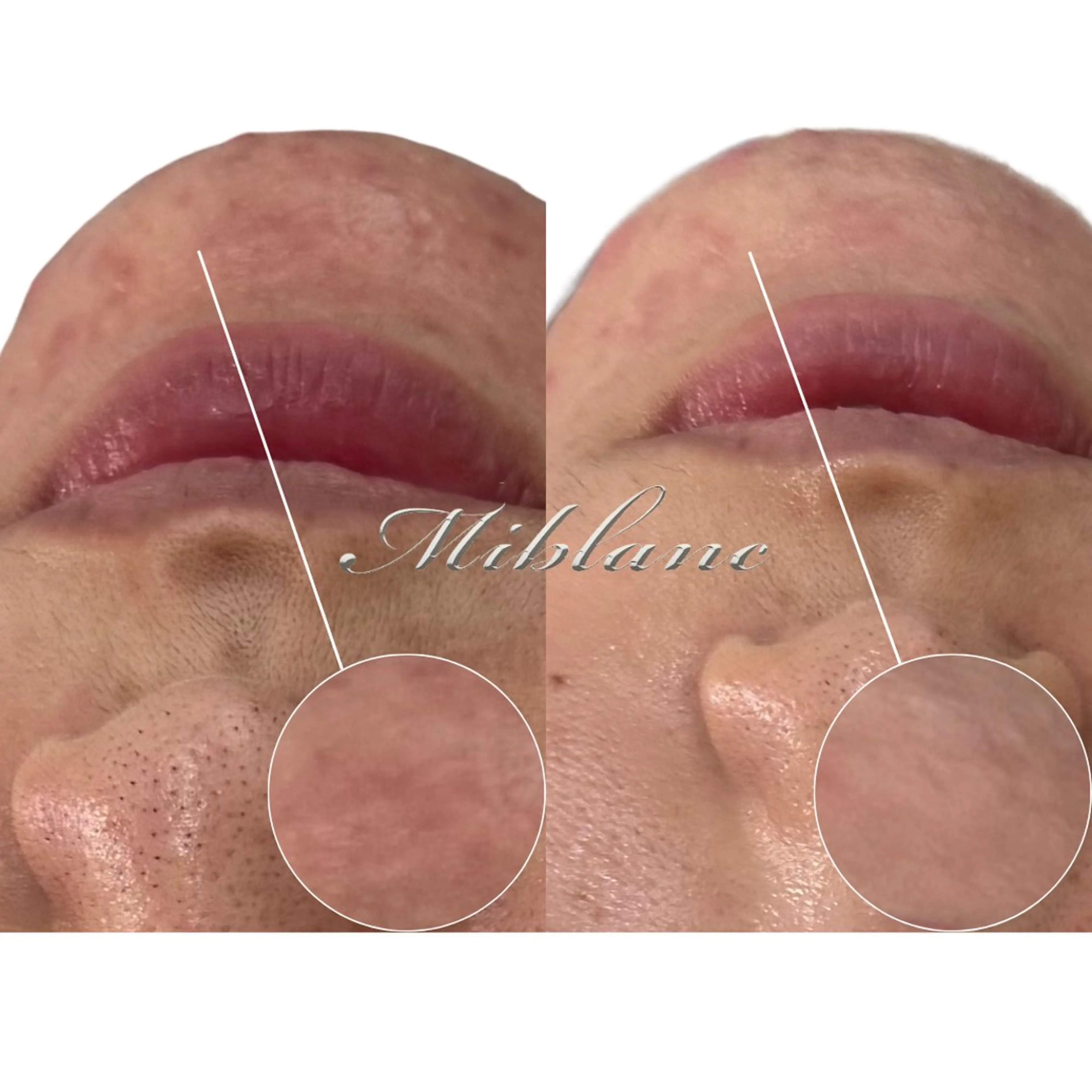 【モニター募集🧖🏻‍♀️】《肌荒れ/炎症鎮静》美肌光フェイシャル 通常価格 ￥8,980→の写真