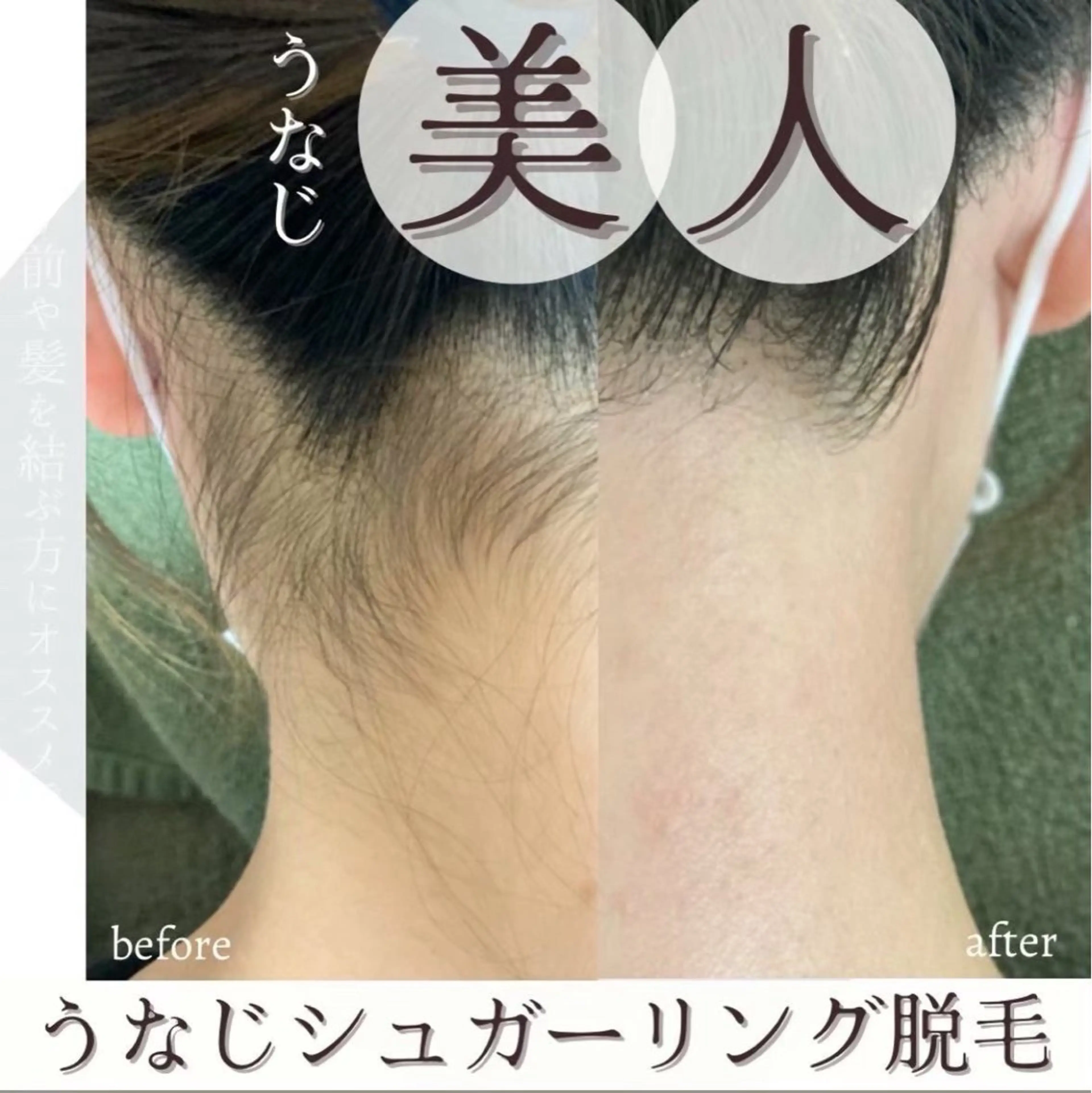 うなじシュガーリング脱毛🍯💓アップスタイルもツルツルもちもちうなじ美人✨ デザイン込みの写真