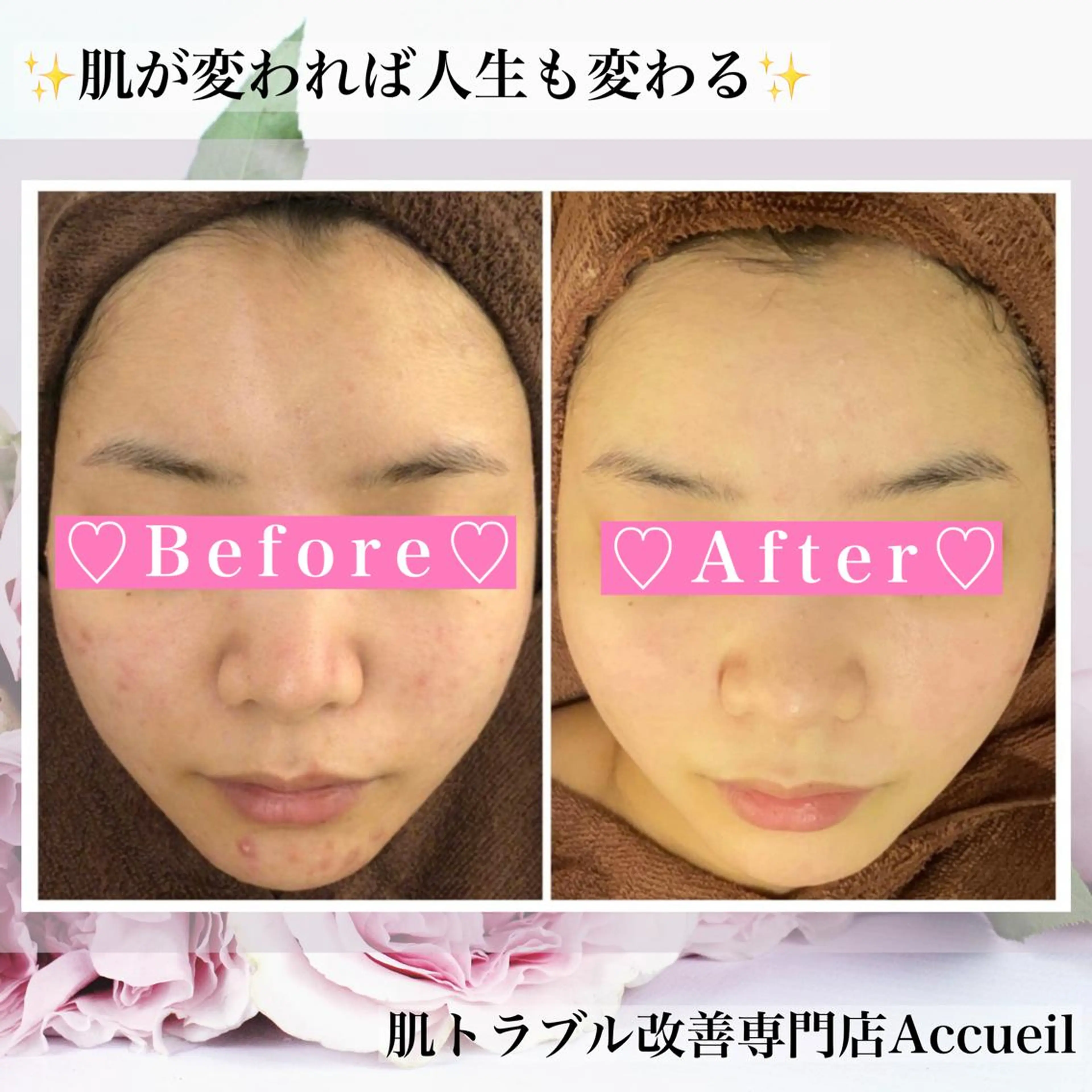 ミディアム カラー パーマ ヘアアレンジ メンズ キッズ ネイル マツエク・マツパ アイブロウ エステ リラク アクール　齋藤 ♡肌トラブル卒業のエステ・リラクイメージ